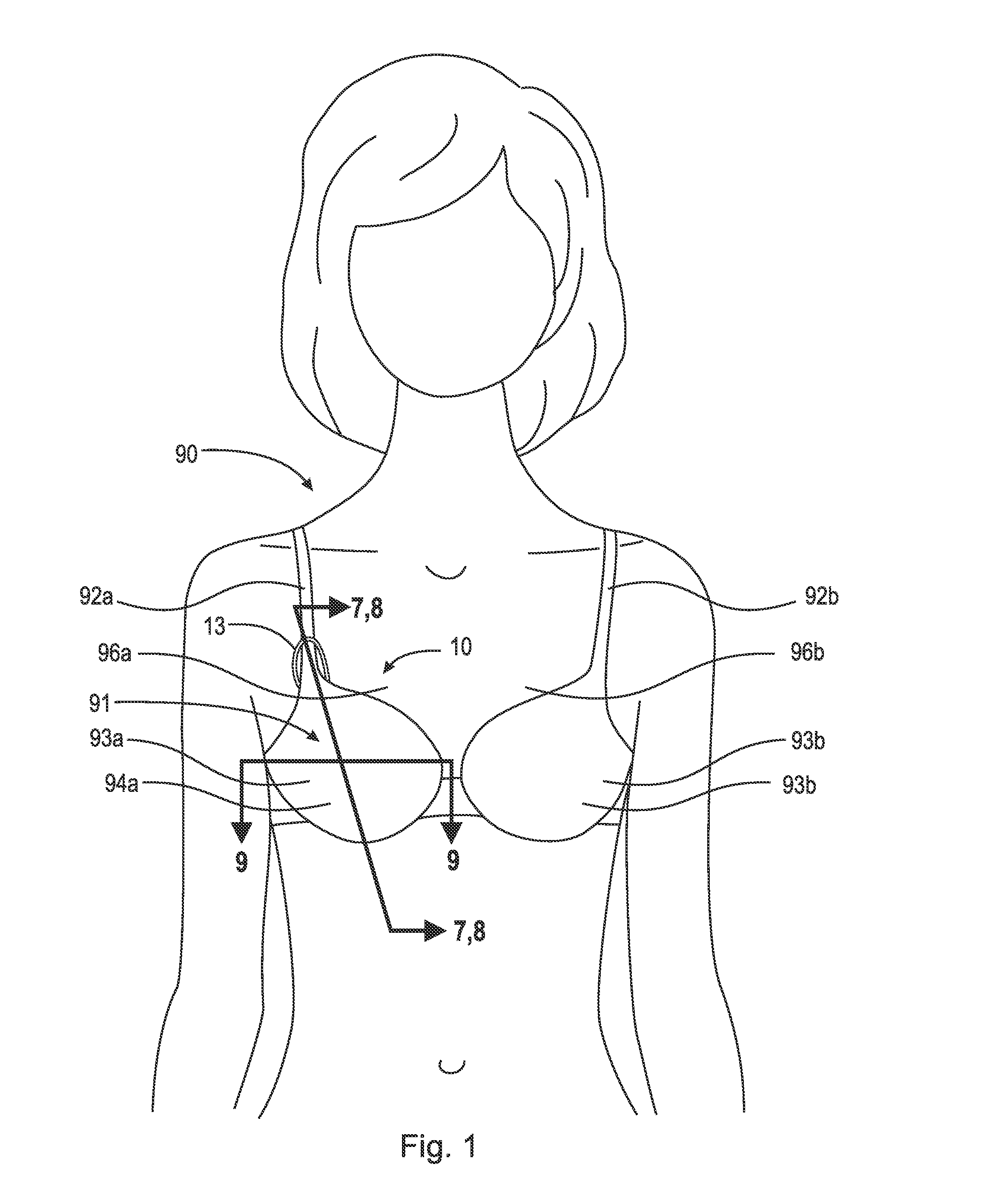 Thermal device for treating breastfeeding conditions
