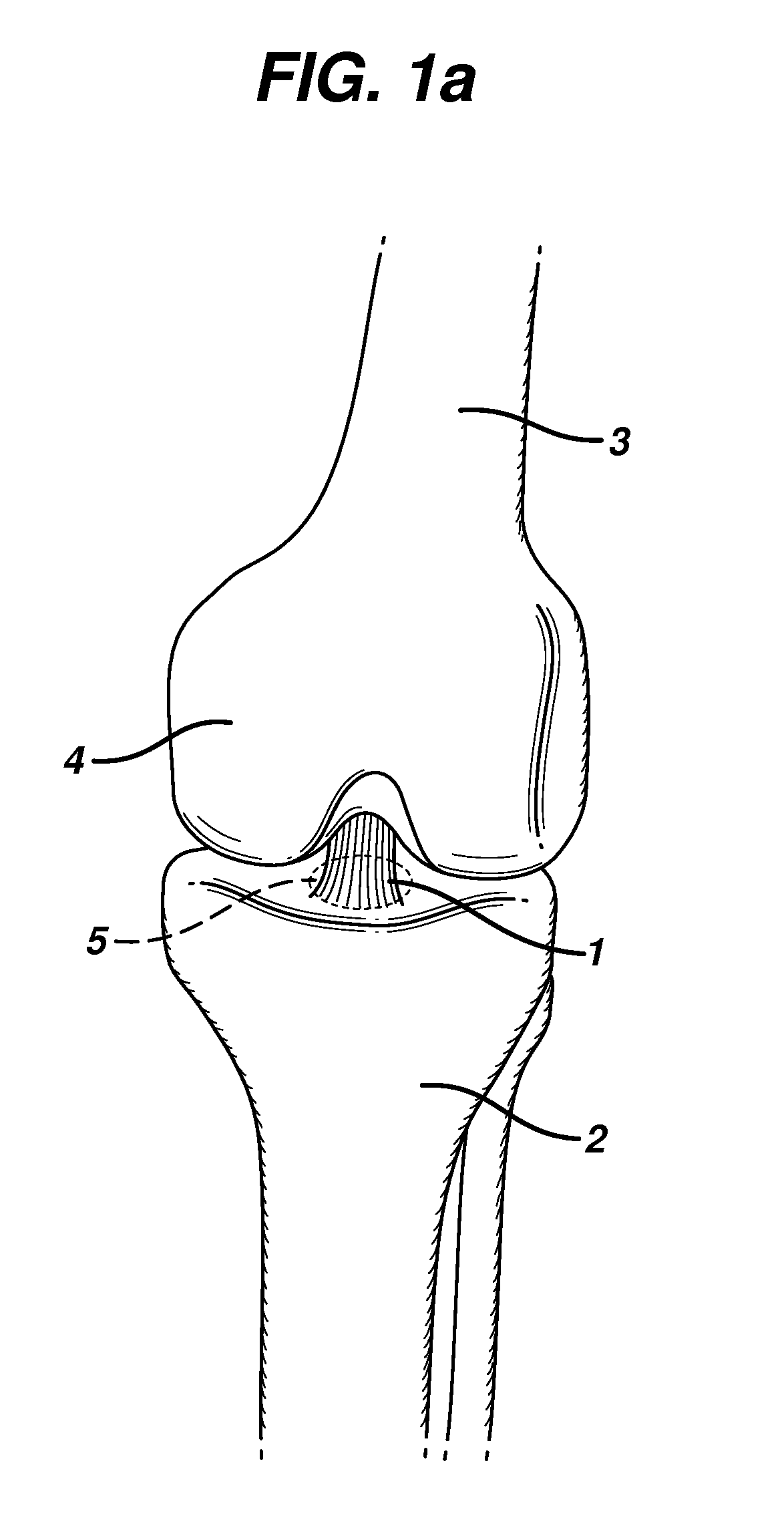 Method for anchoring autologous or artificial tendon grafts in bone