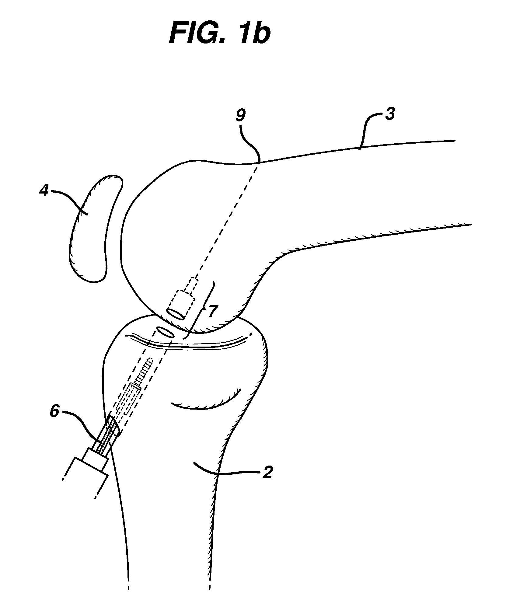 Method for anchoring autologous or artificial tendon grafts in bone