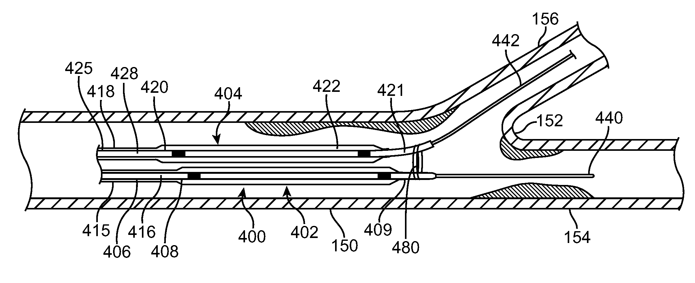 Method and apparatus for treating stenoses at bifurcated regions