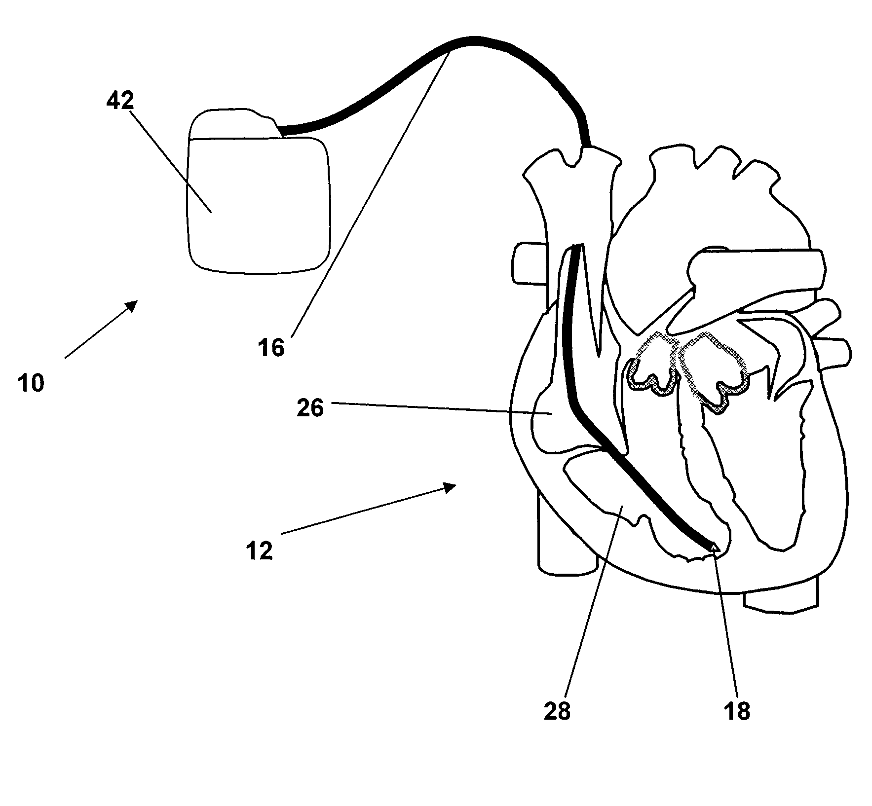 Monitoring system for sleep disordered breathing