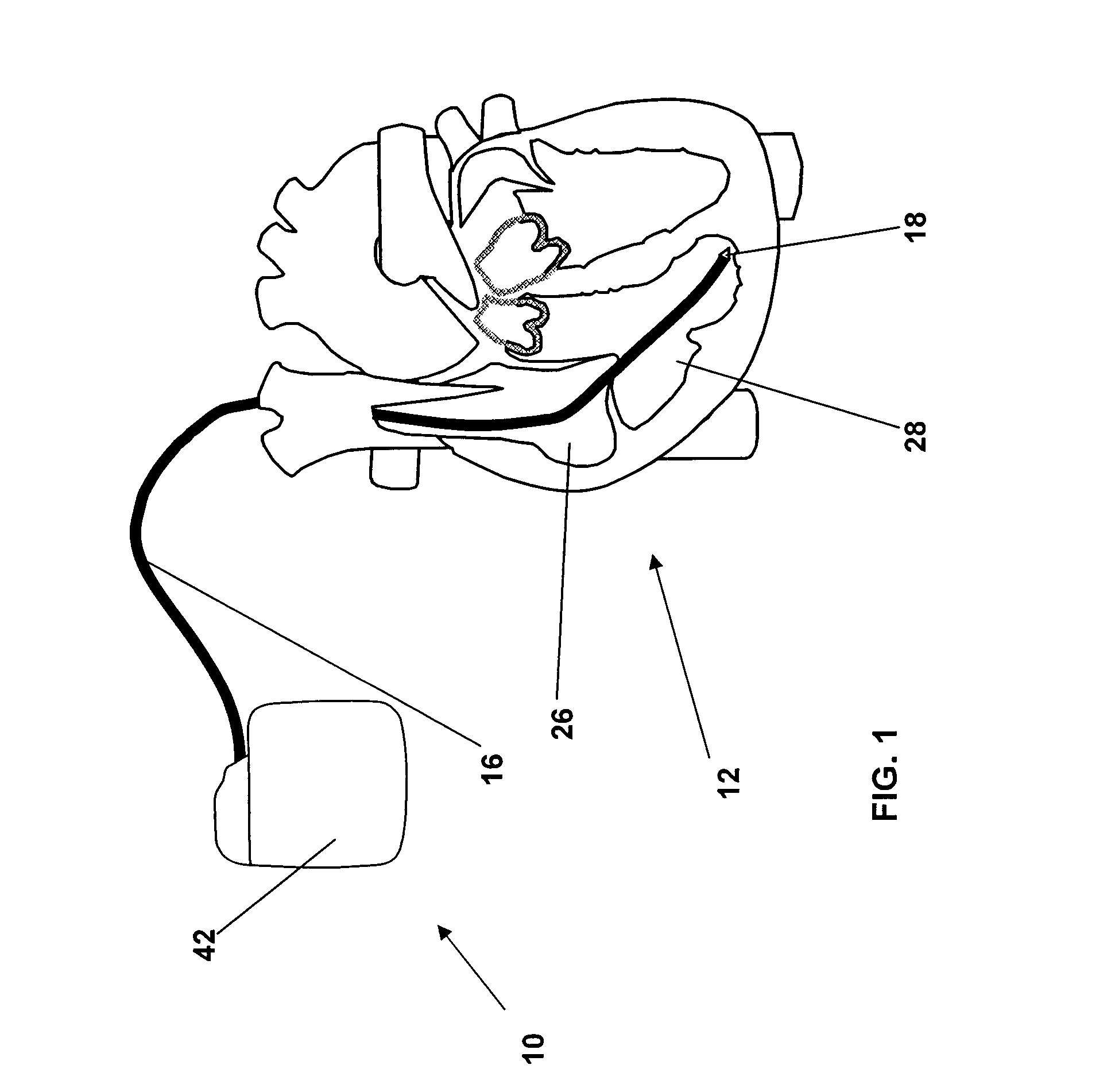 Monitoring system for sleep disordered breathing
