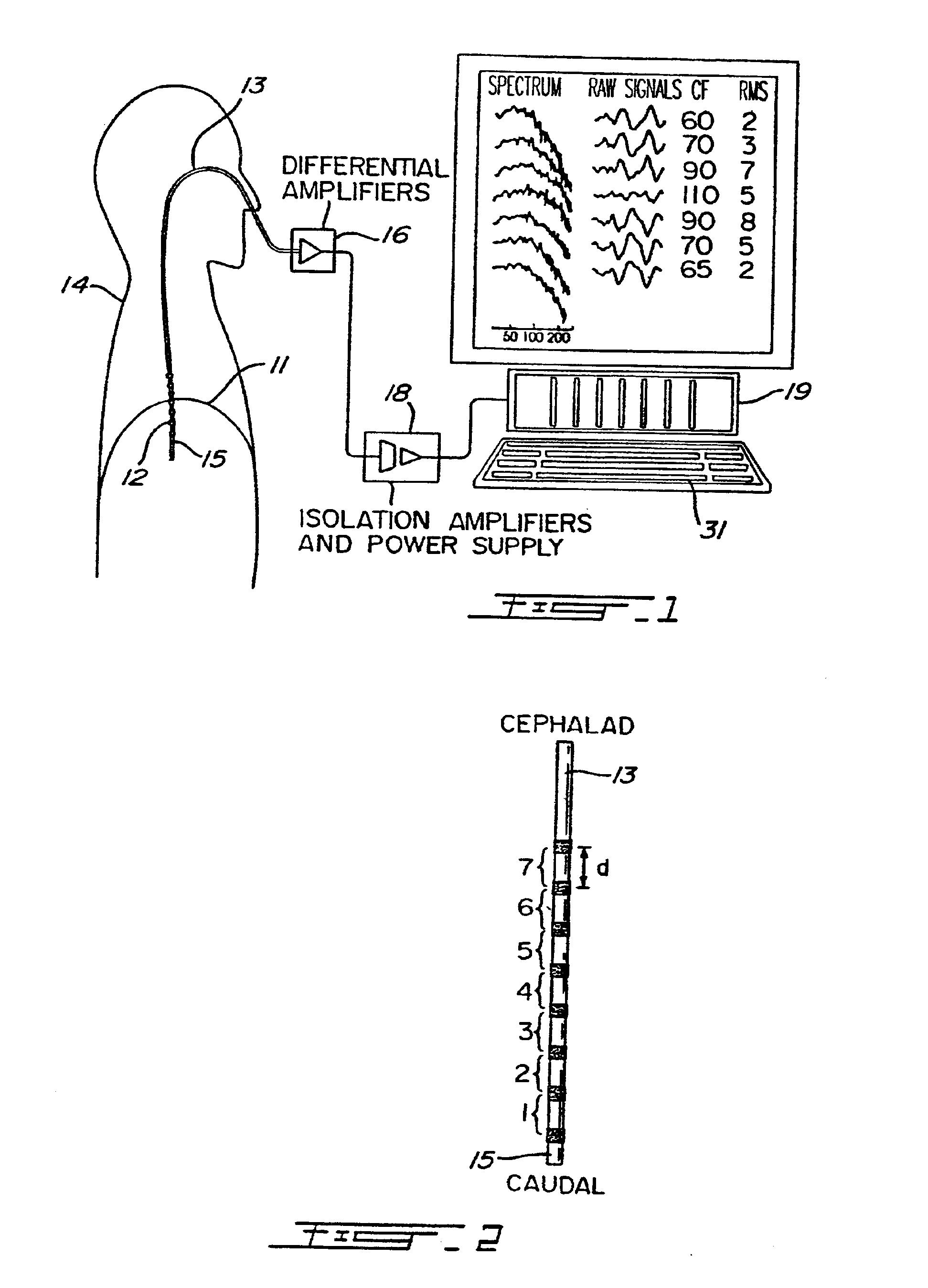Method and system for producing a higher quality electromyographic signal from an electrode array