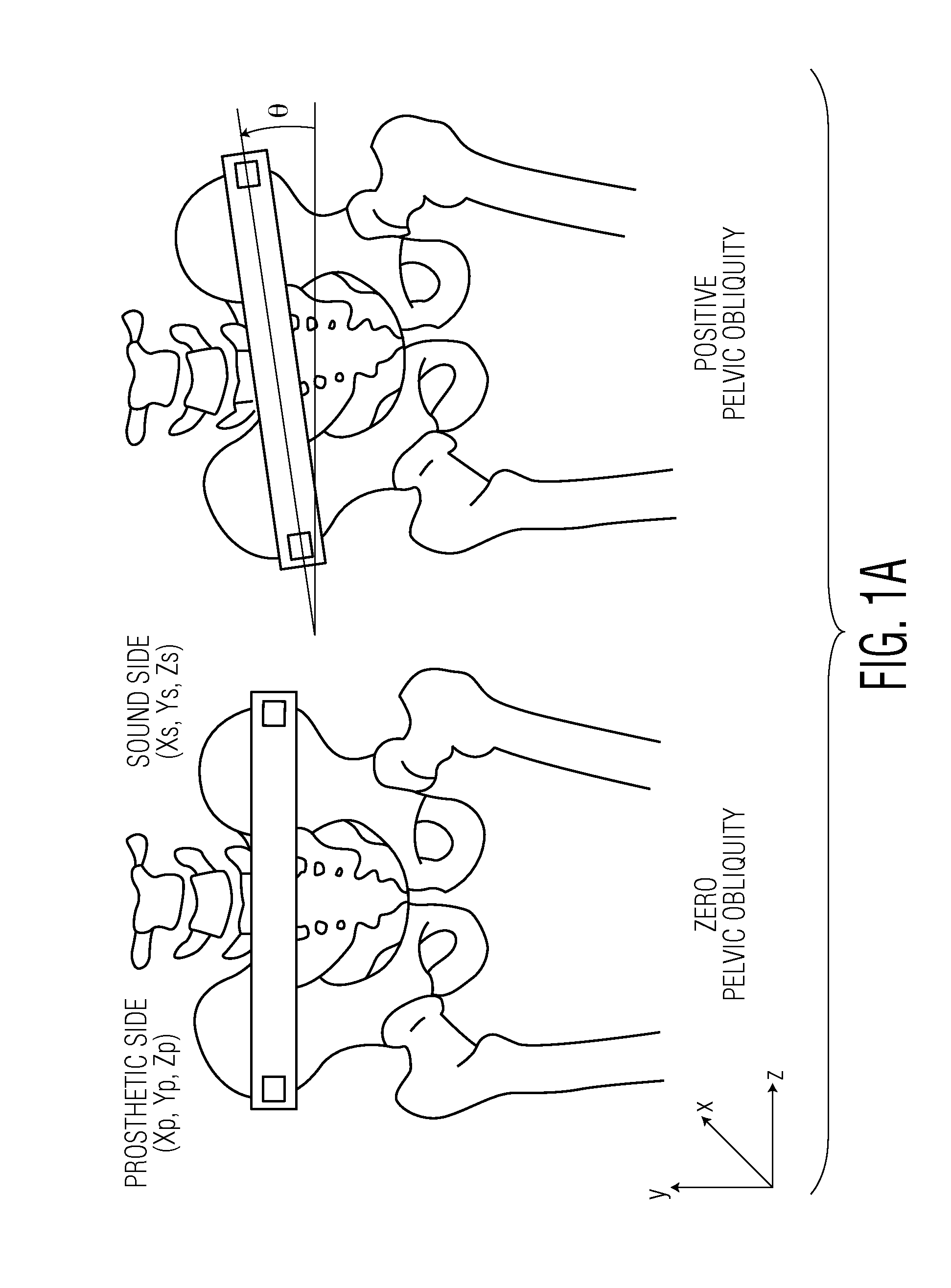 Method for aligning an acetabular cup