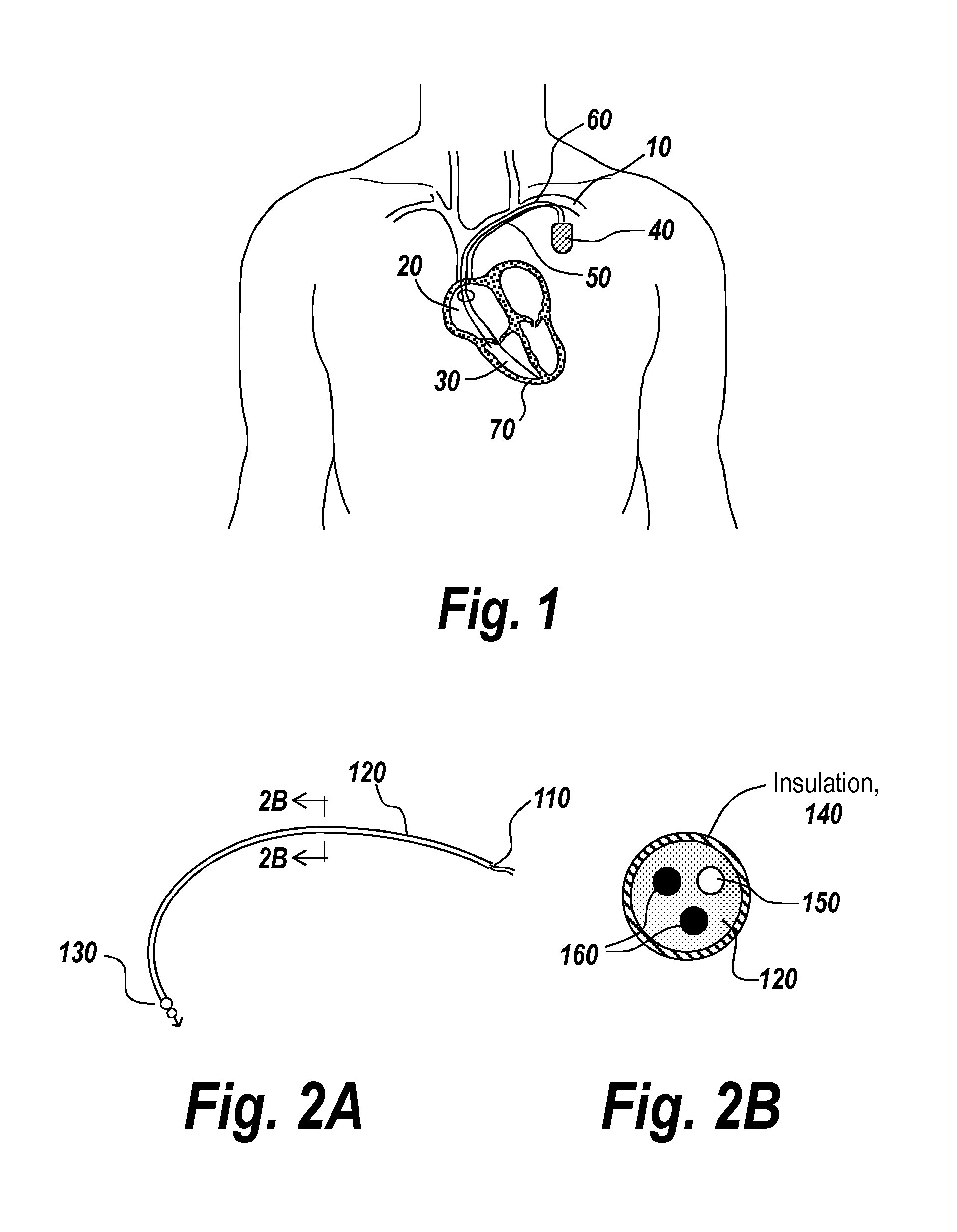 Implantable Medical Devices, Methods of Use, and Apparatus for Extraction Thereof
