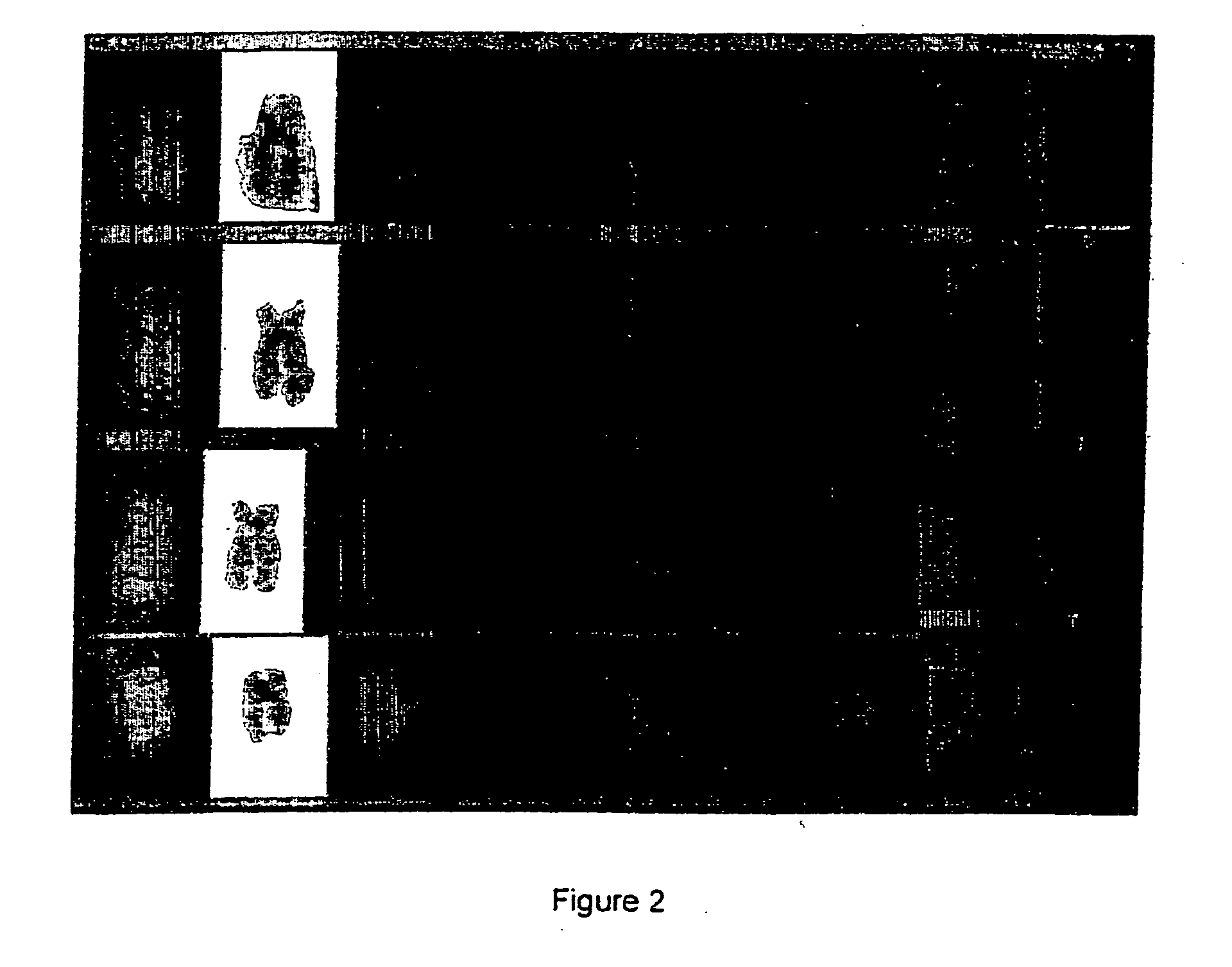 Method for the diagnosis of lymphoproliferative diseases