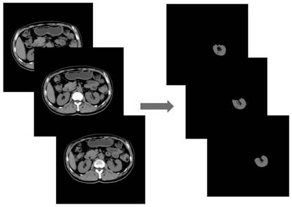 Kidney image segmentation method based on shape prior