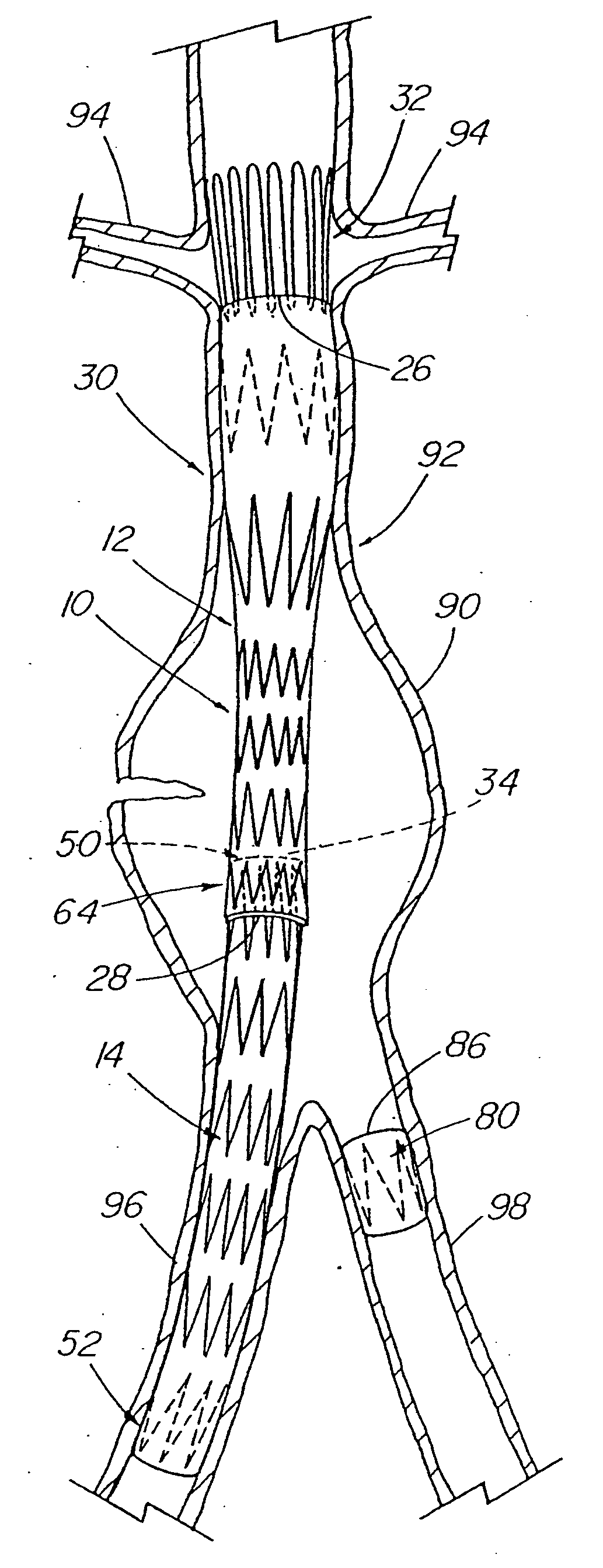 Modular stent graft assembly and use thereof