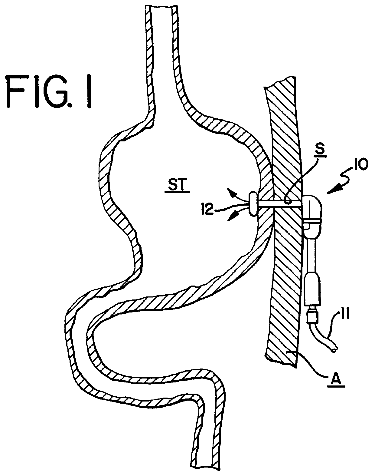 Retention balloon for a corporeal access tube assembly