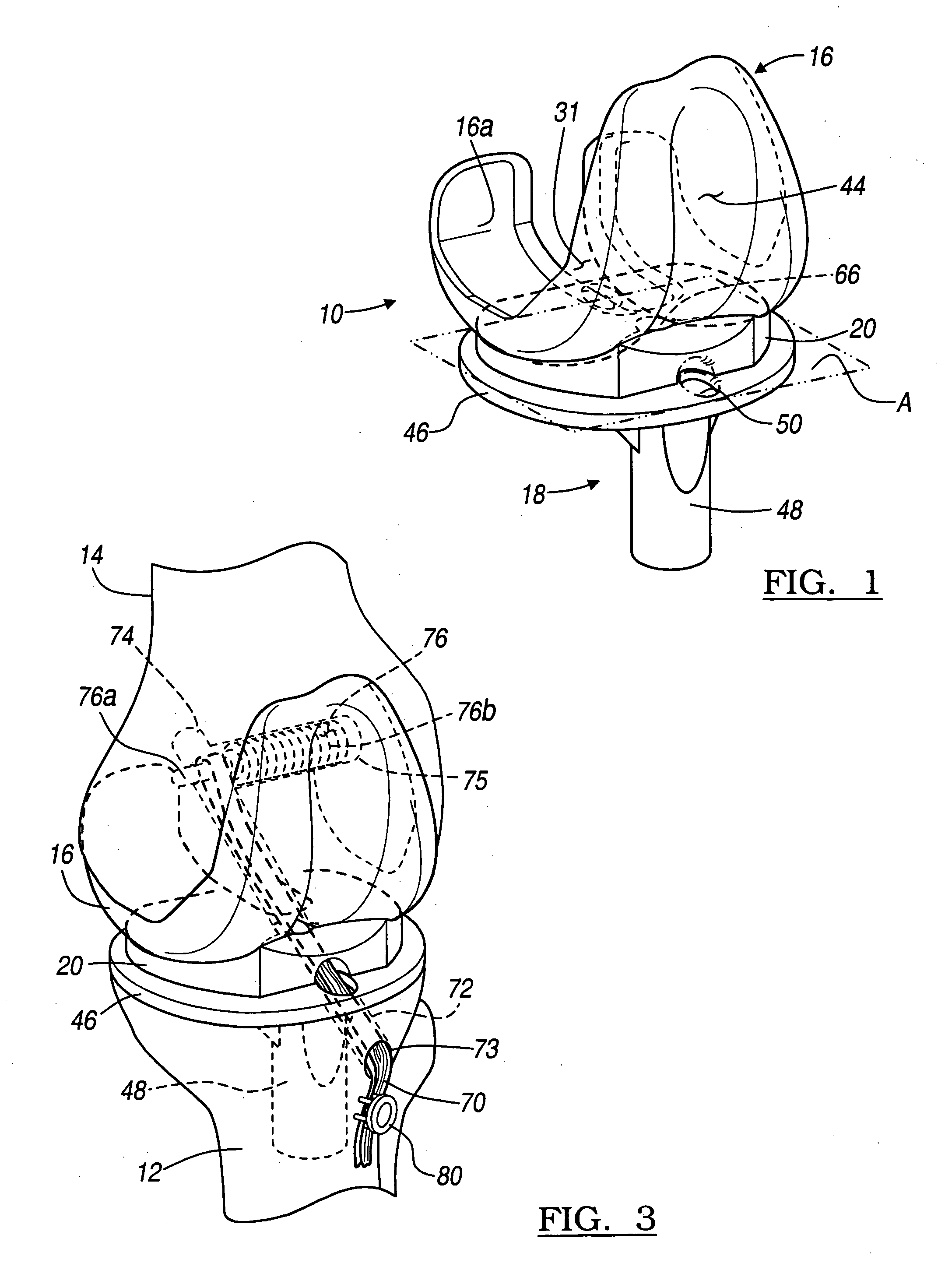 Integrated prosthetic assembly