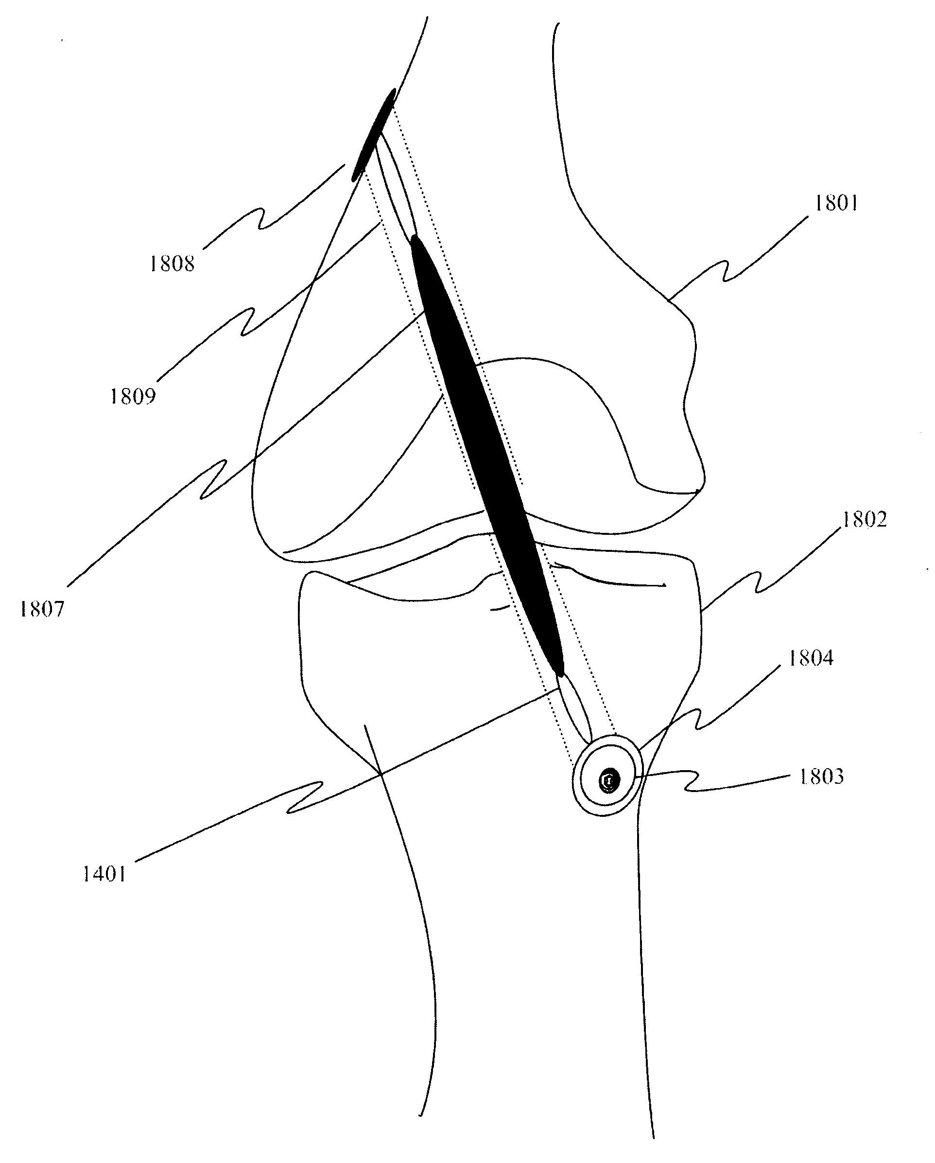 Method and apparatus for aperture fixation by securing flexible material with a knotless fixation device