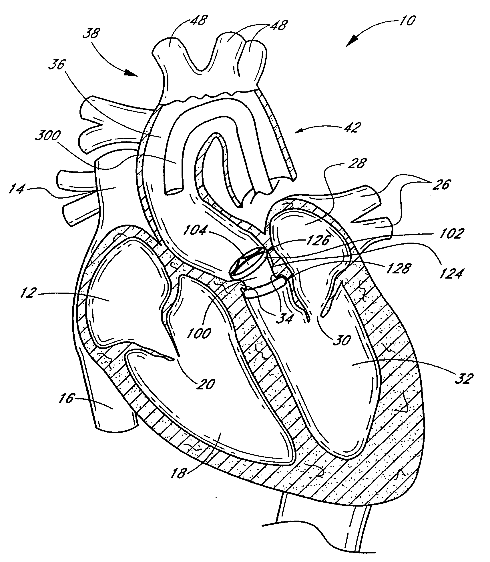 Nonstented heart valves with formed in situ support