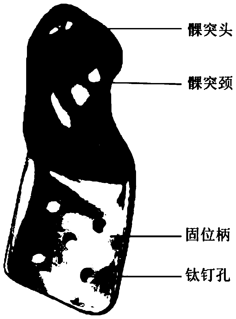 Design method of customized condylar prosthesis