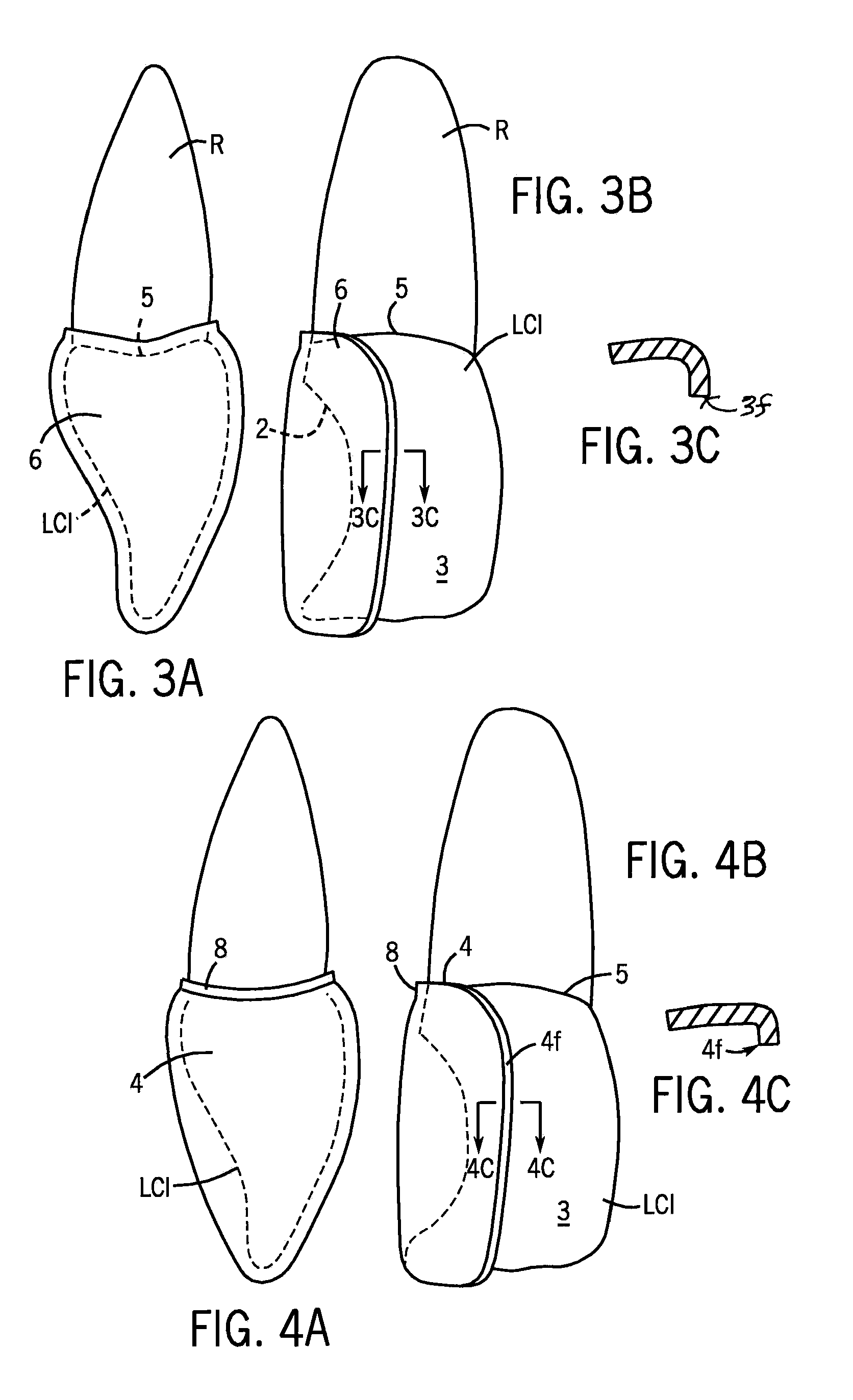 Dental Composite Dispenser For Injection Molded Filling Techniques