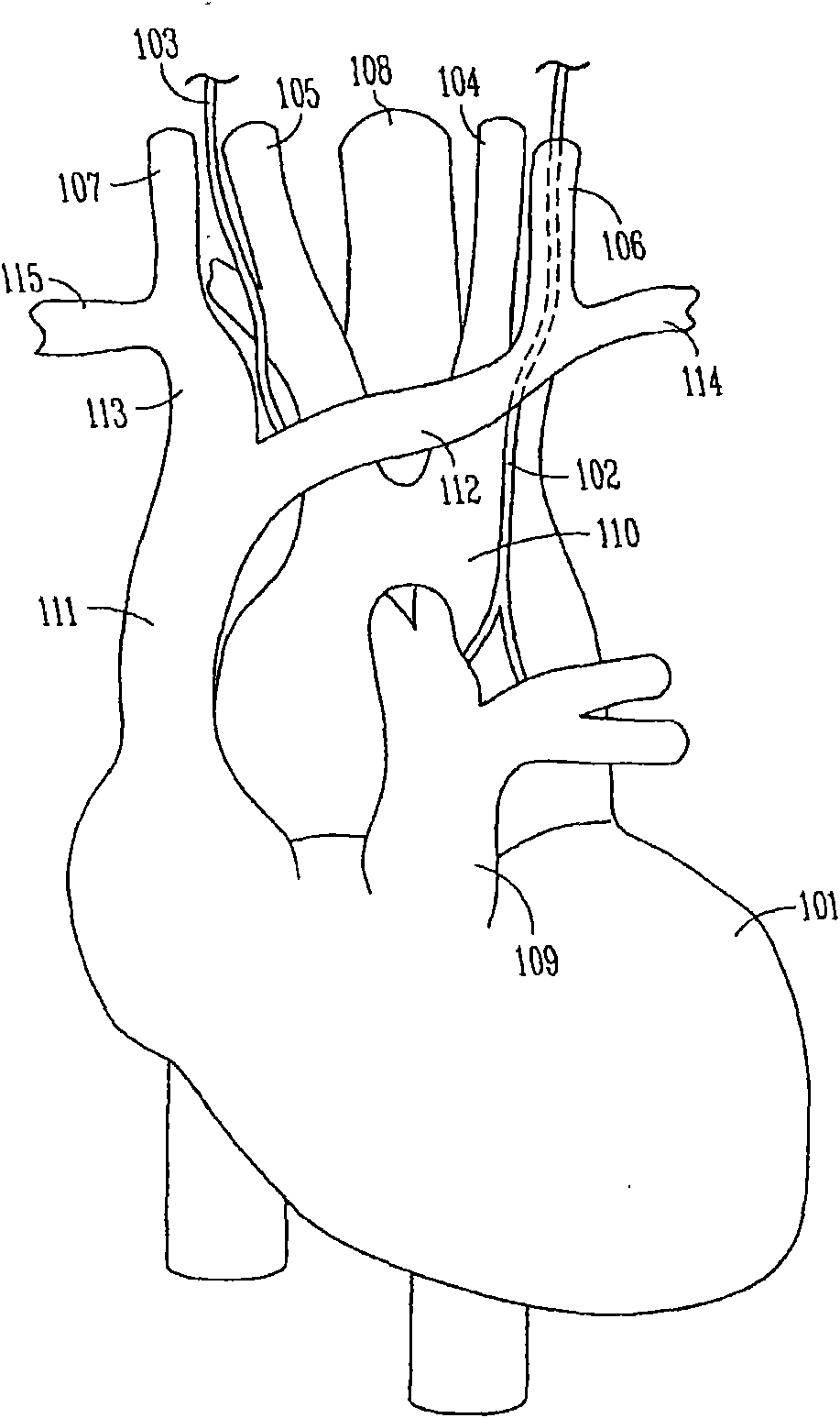 Unidirectional neural stimulation systems, devices and methods