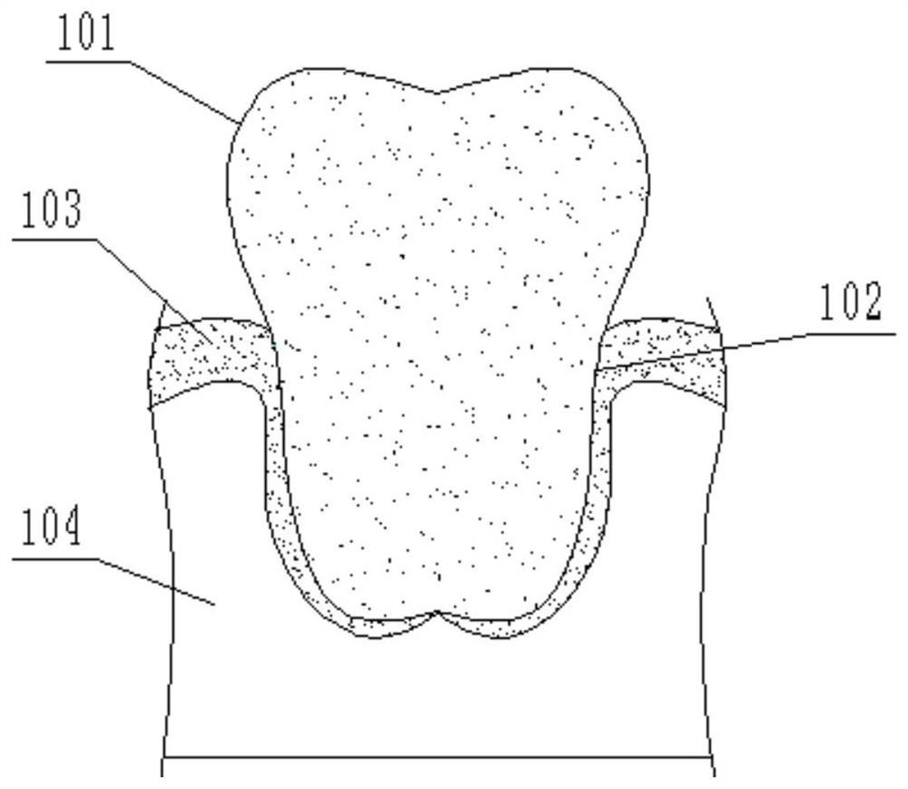 A mucoperiosteal flap spreader for oral implantation