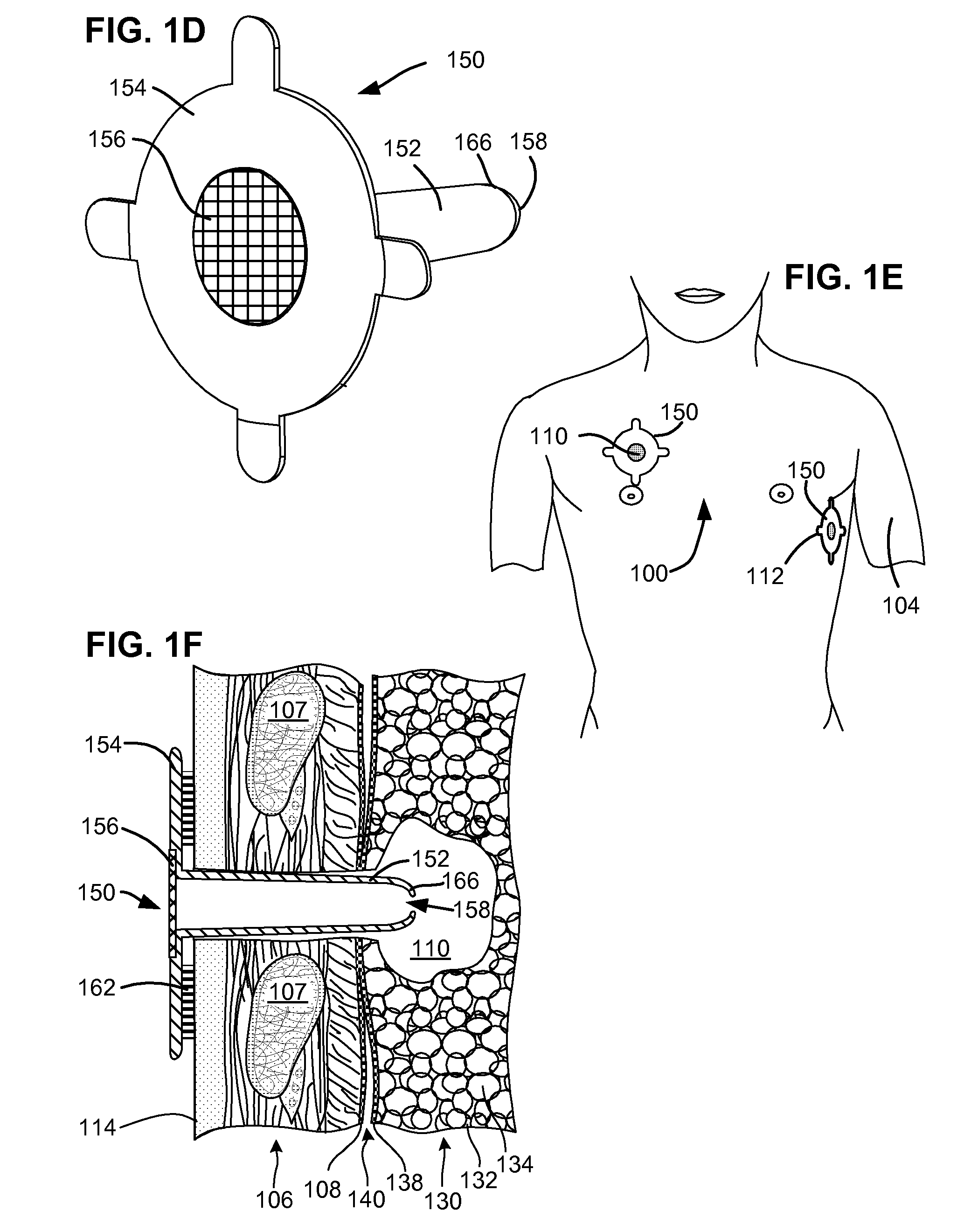 Methods and devices for follow-up care and treatment of a pneumostoma