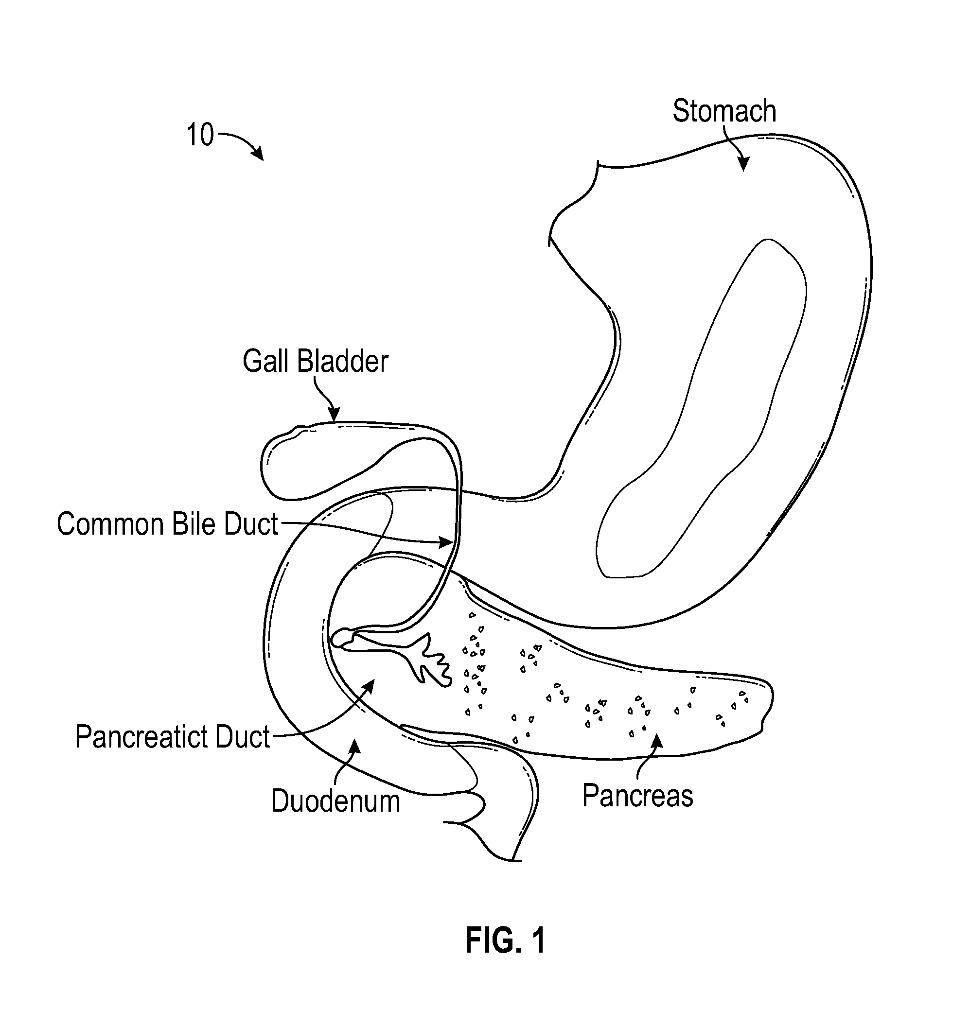 Bioelectronic signal processor and procedure to locate and destroy pancreatic cancer cells