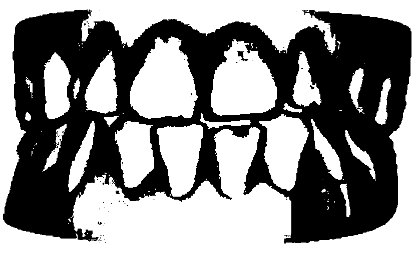 A Collision Detection Method for the Calculation of Upper and Lower Jaw Occlusal Areas