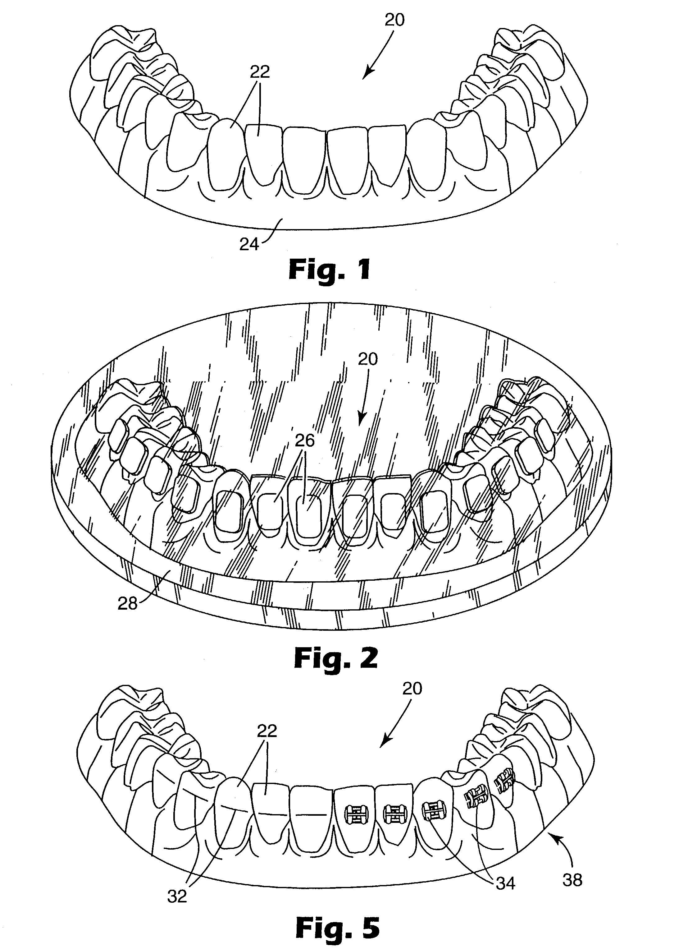 Method and apparatus for indirect bonding of orthodontic appliances