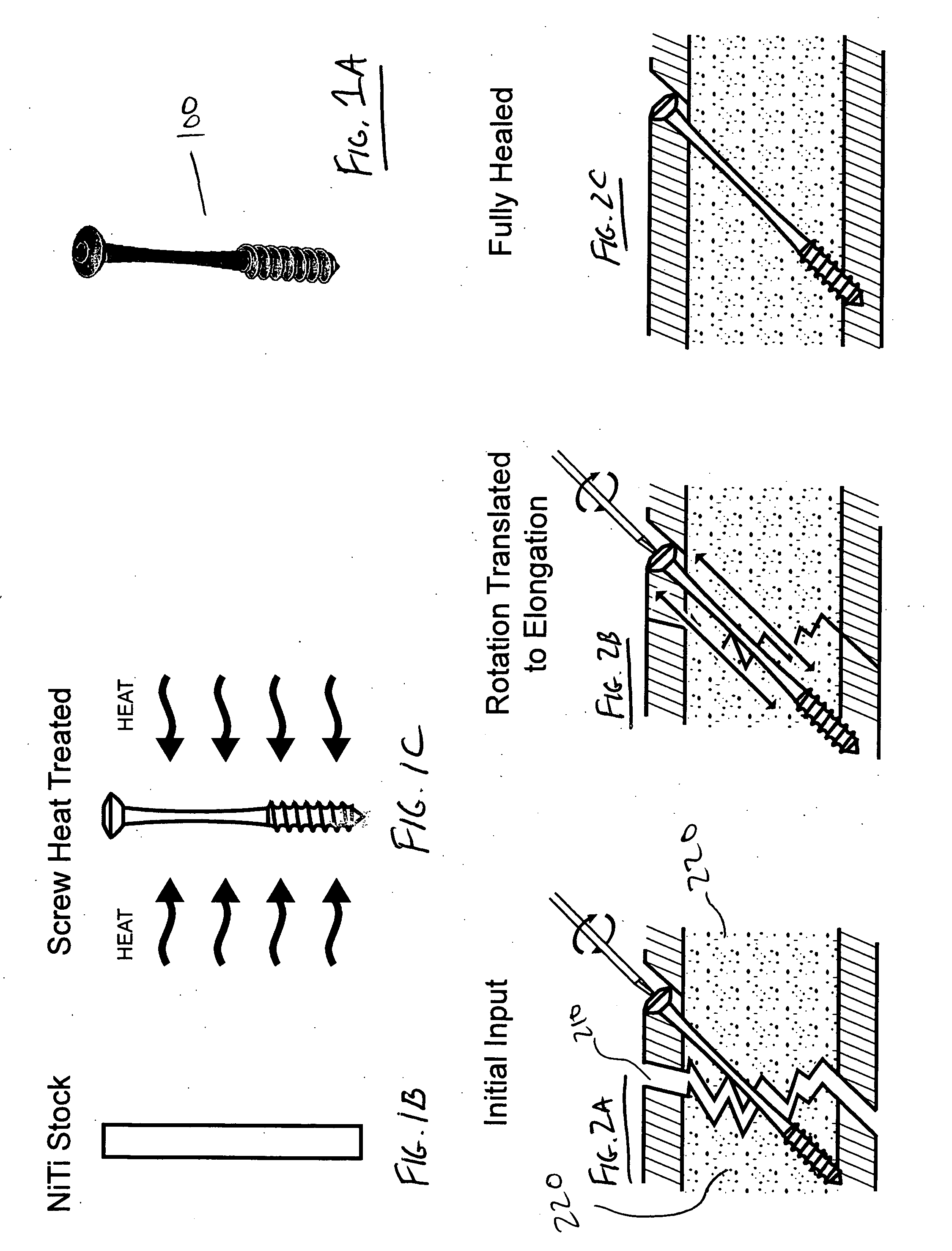 Osteosynthetic implants and methods of use and manufacture