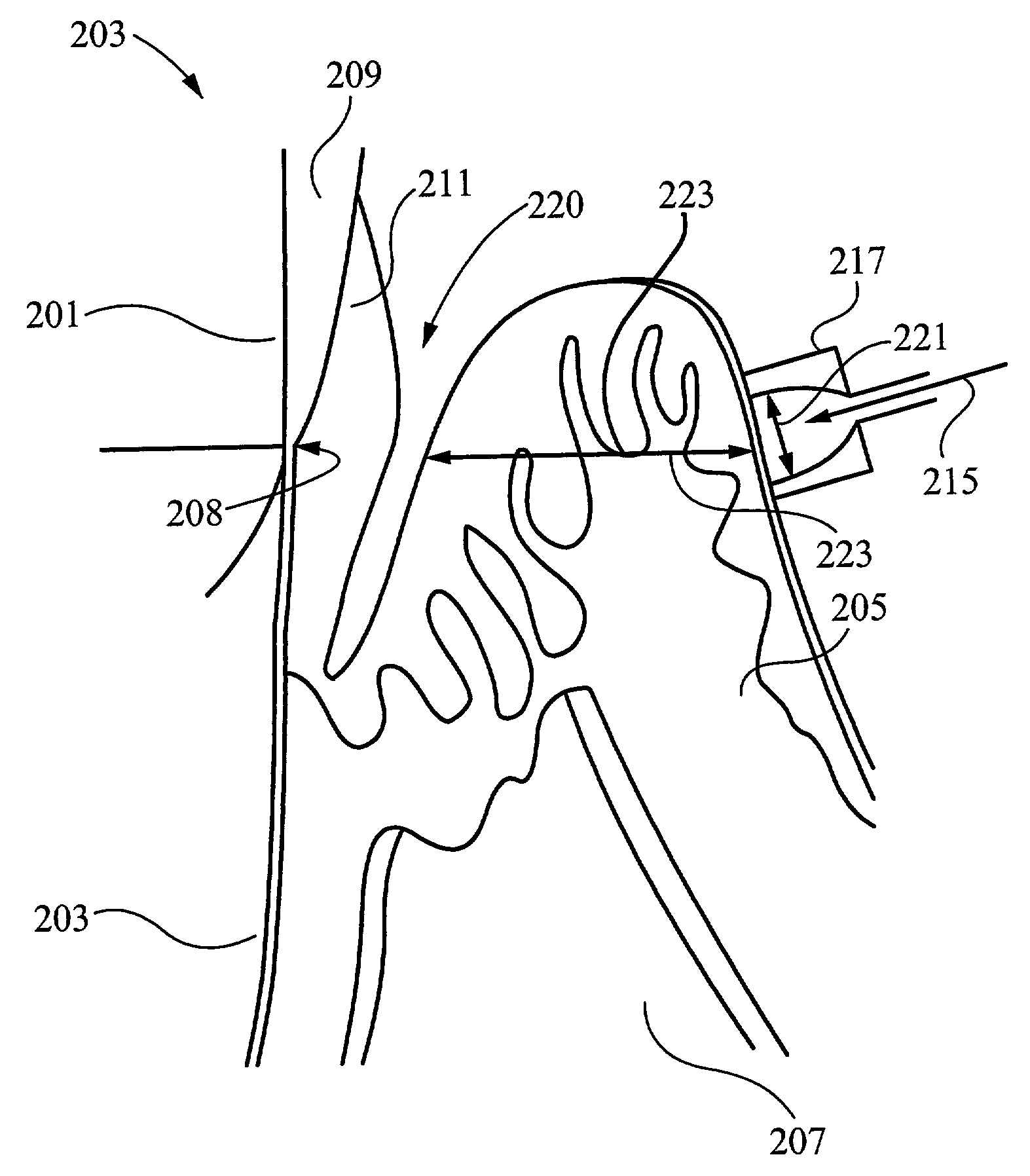 Method of periodontal laser treatment