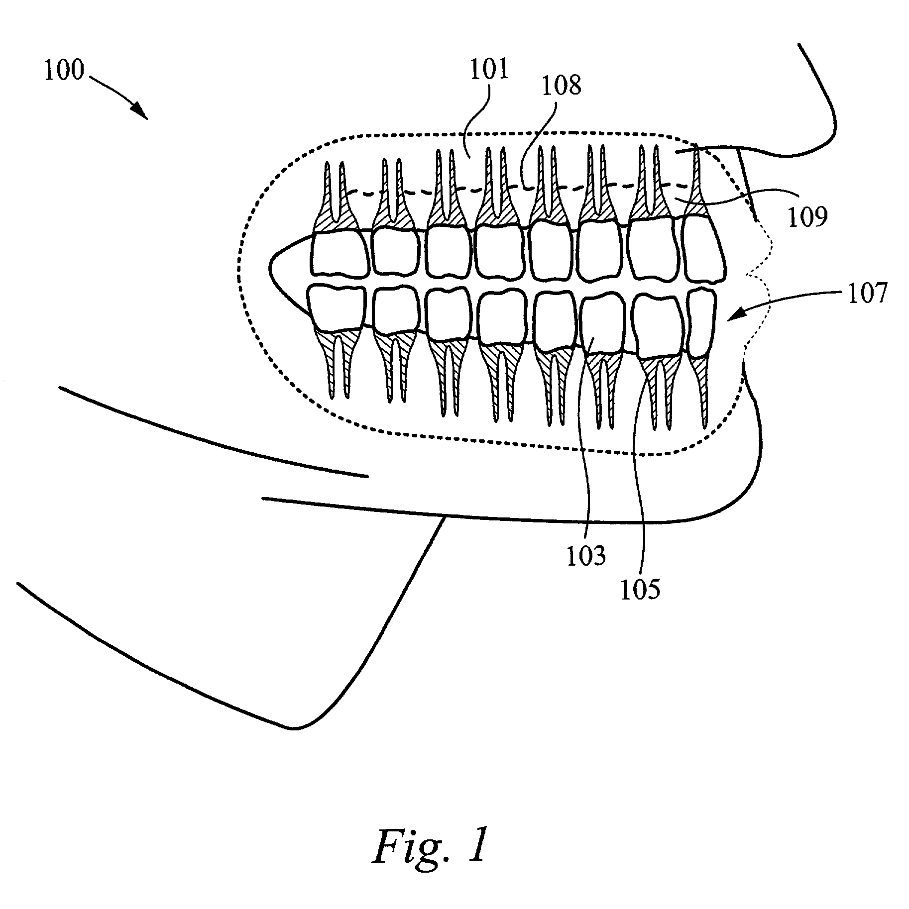 Method of periodontal laser treatment