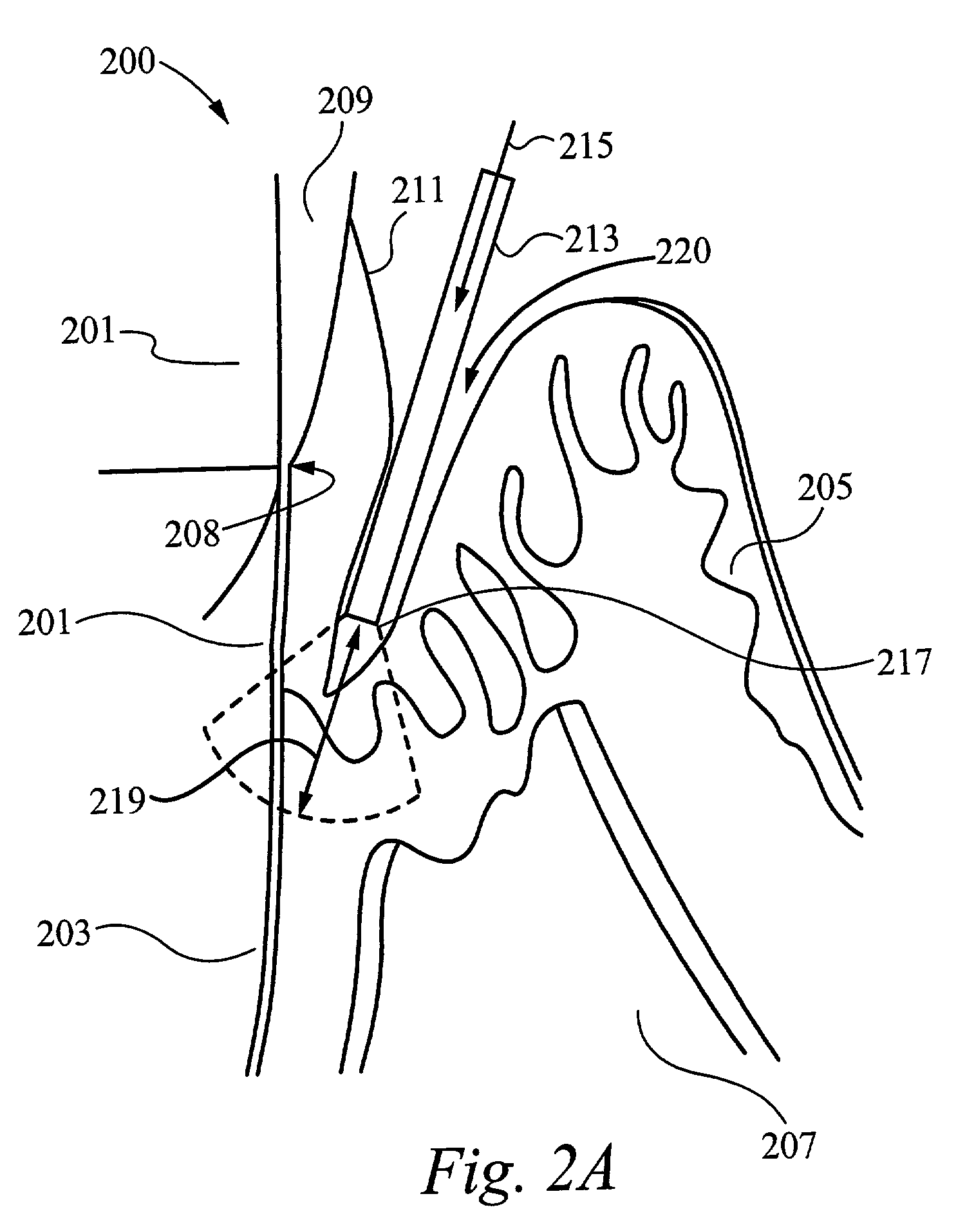 Method of periodontal laser treatment