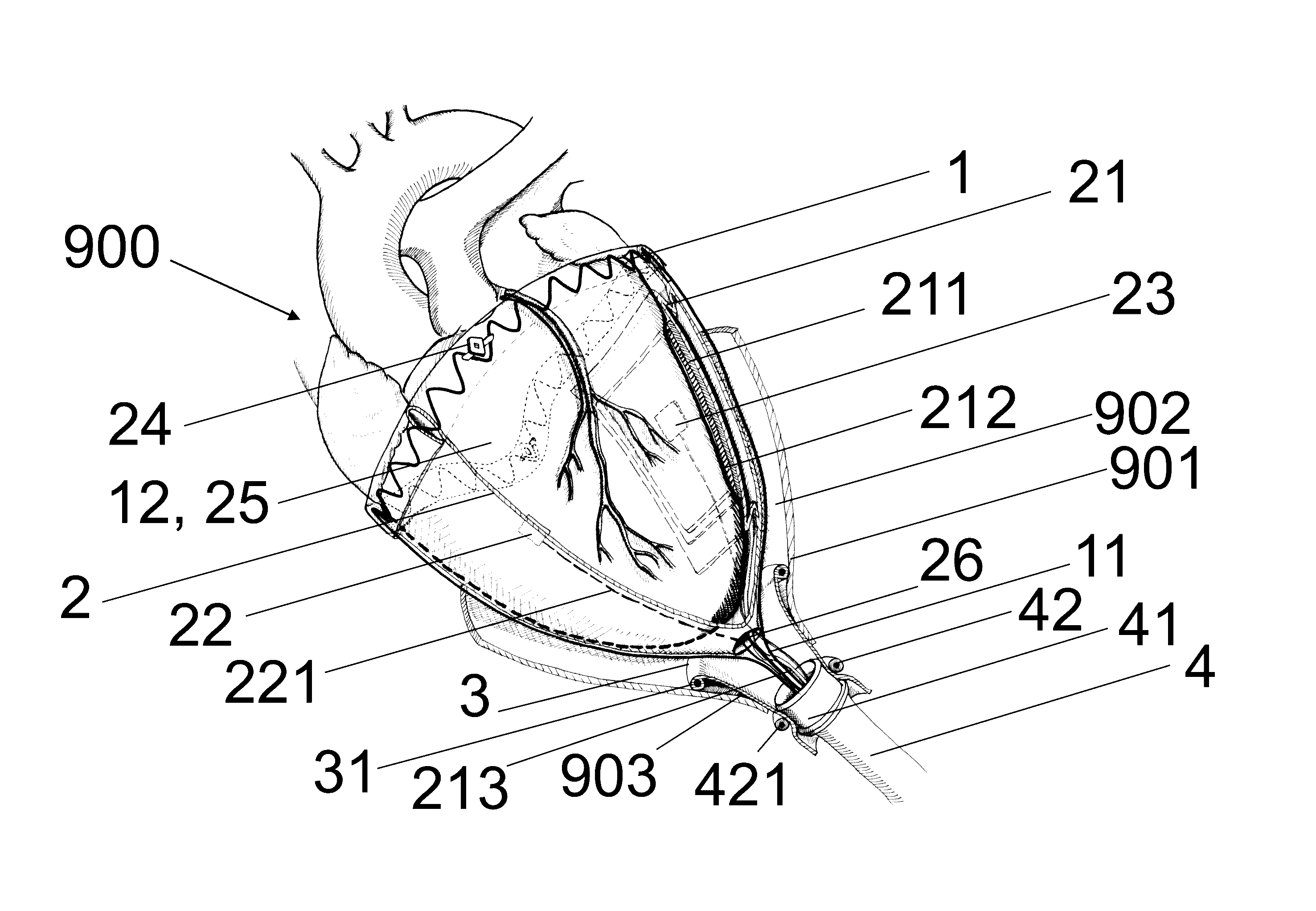Implantable device for the locationally accurate delivery and administration of substances into the pericardium or onto the surface of the heart
