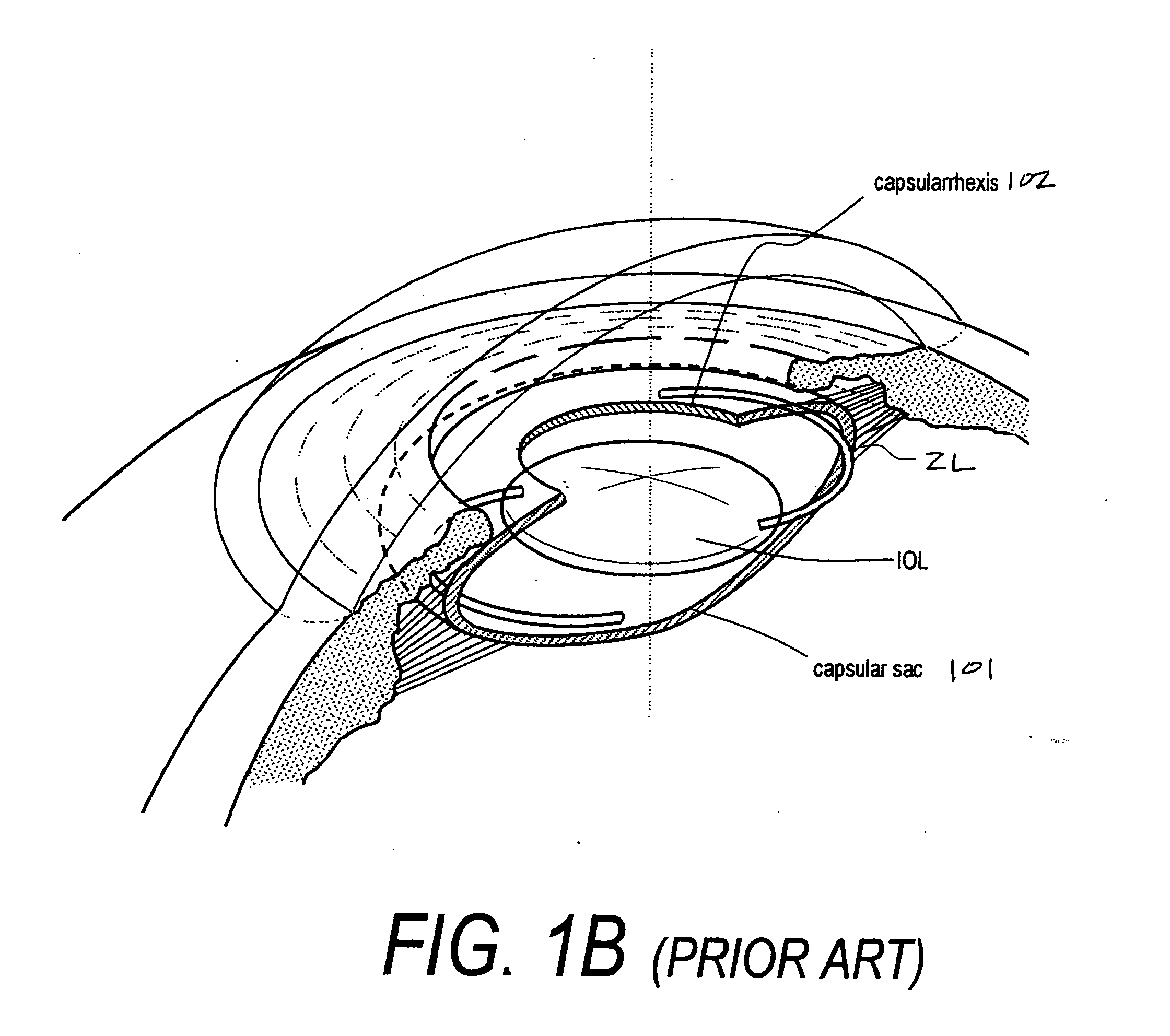 Ophthalmic devices, methods of use and methods of fabrication