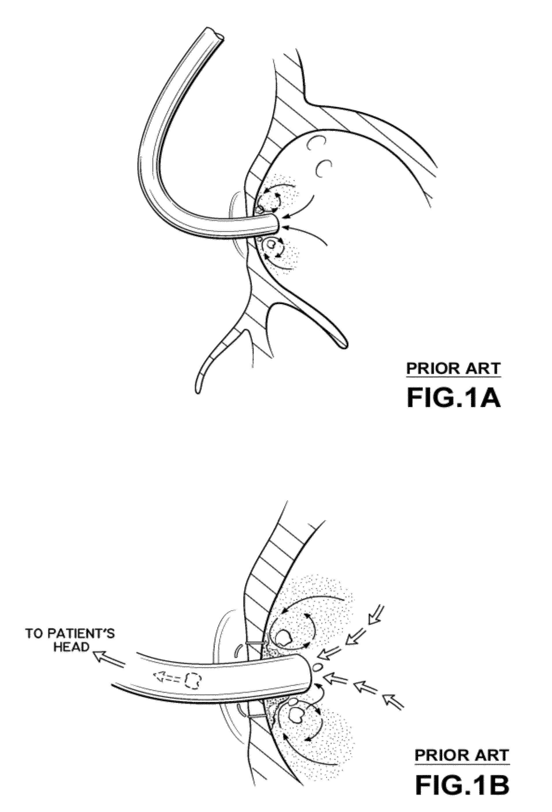 Cannula Systems and Methods