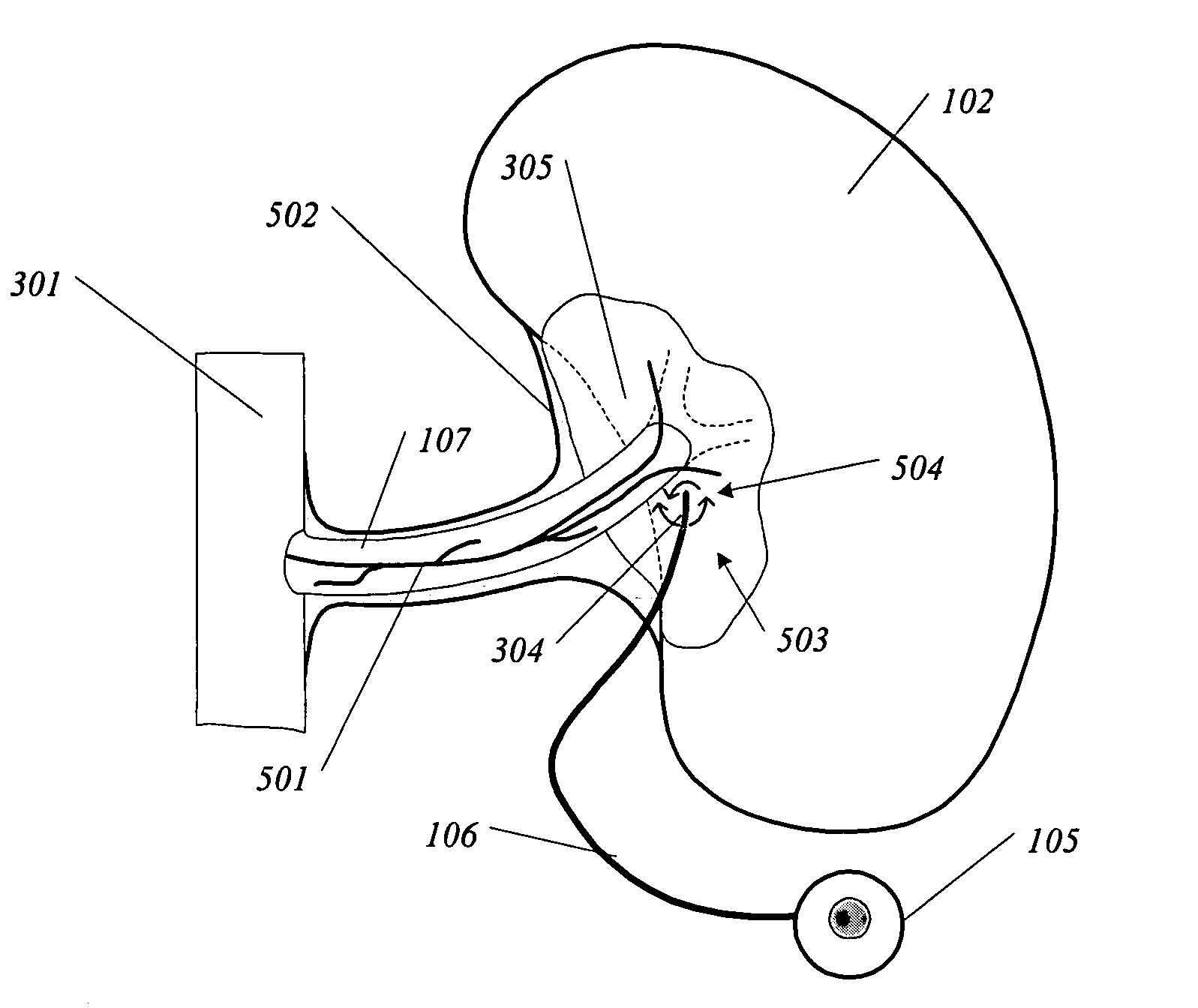 Methods and devices for renal nerve blocking