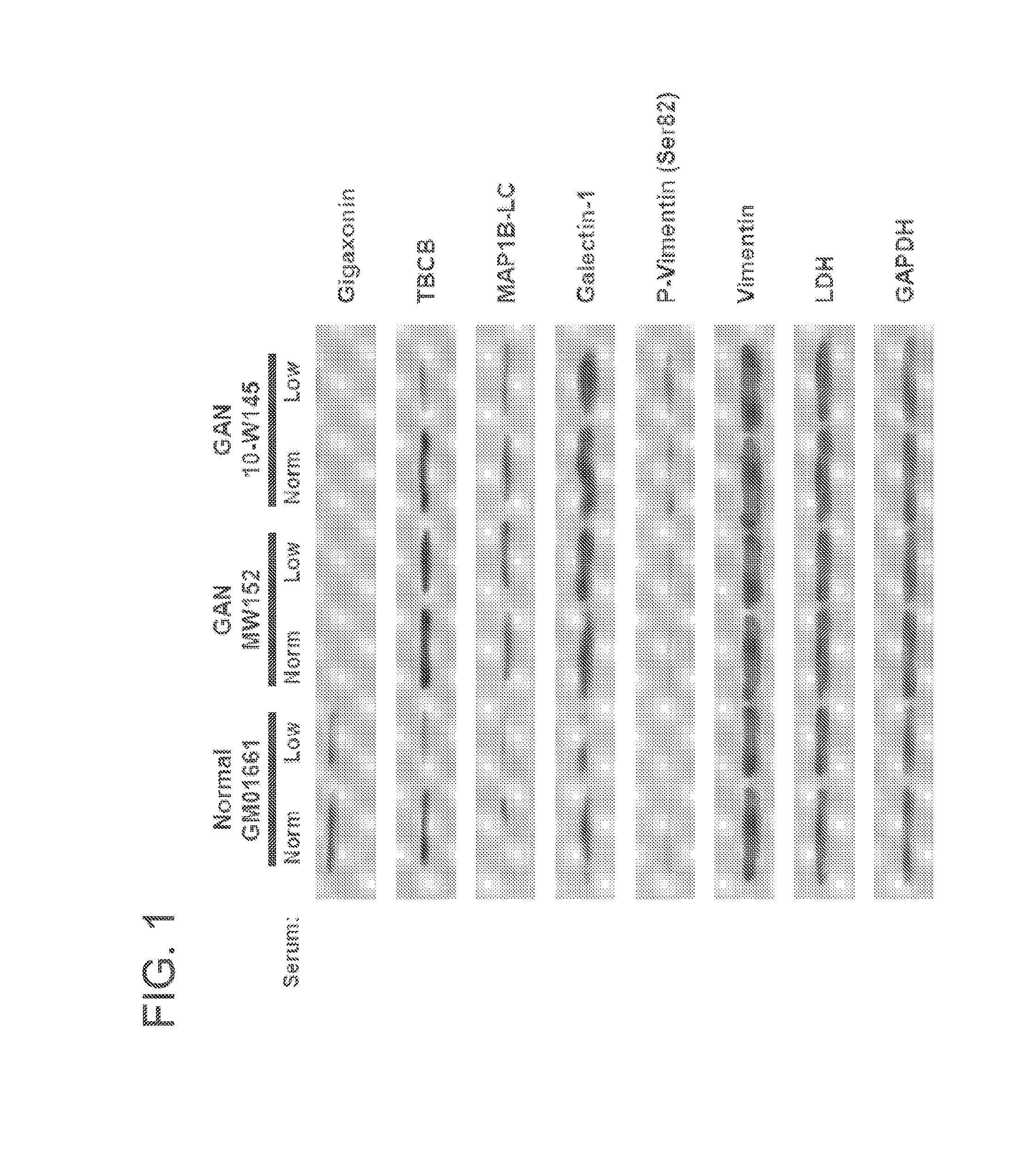 Gigaxonin fusion protein and methods for treating giant axonal neuropathy