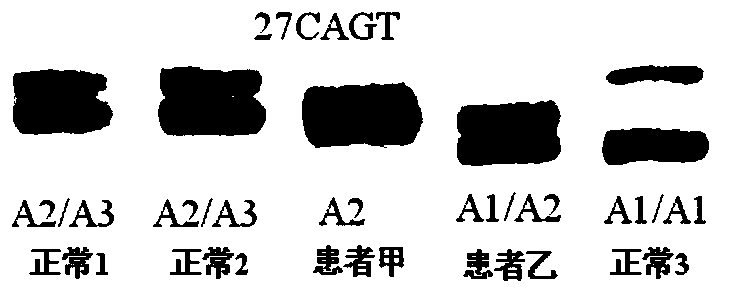 A type I neurofibromatosis pathogenic mutation gene and an etiological diagnostic reagent based on the mutation gene