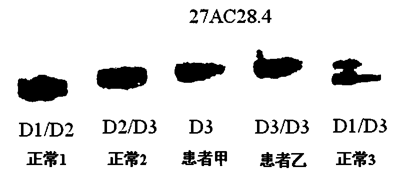 A type I neurofibromatosis pathogenic mutation gene and an etiological diagnostic reagent based on the mutation gene