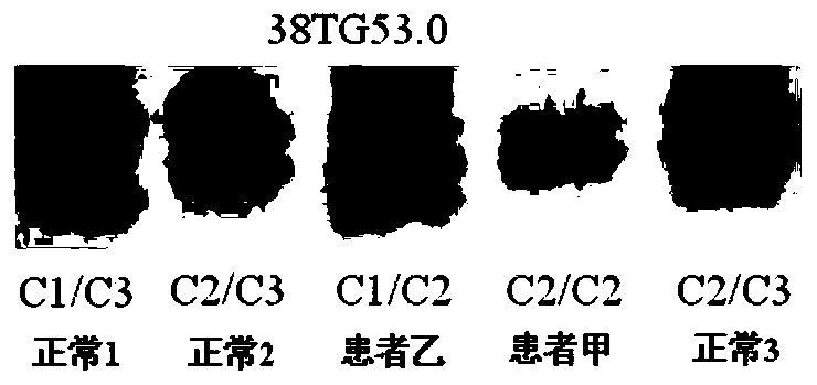 A type I neurofibromatosis pathogenic mutation gene and an etiological diagnostic reagent based on the mutation gene