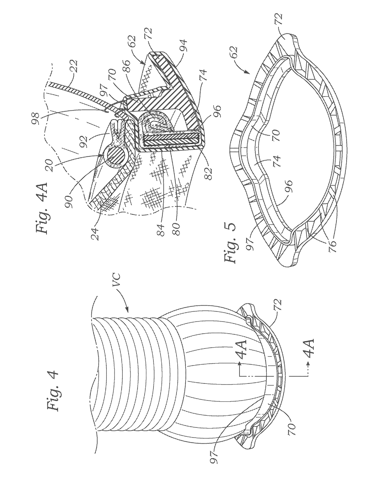 Methods of assembling a valved aortic conduit