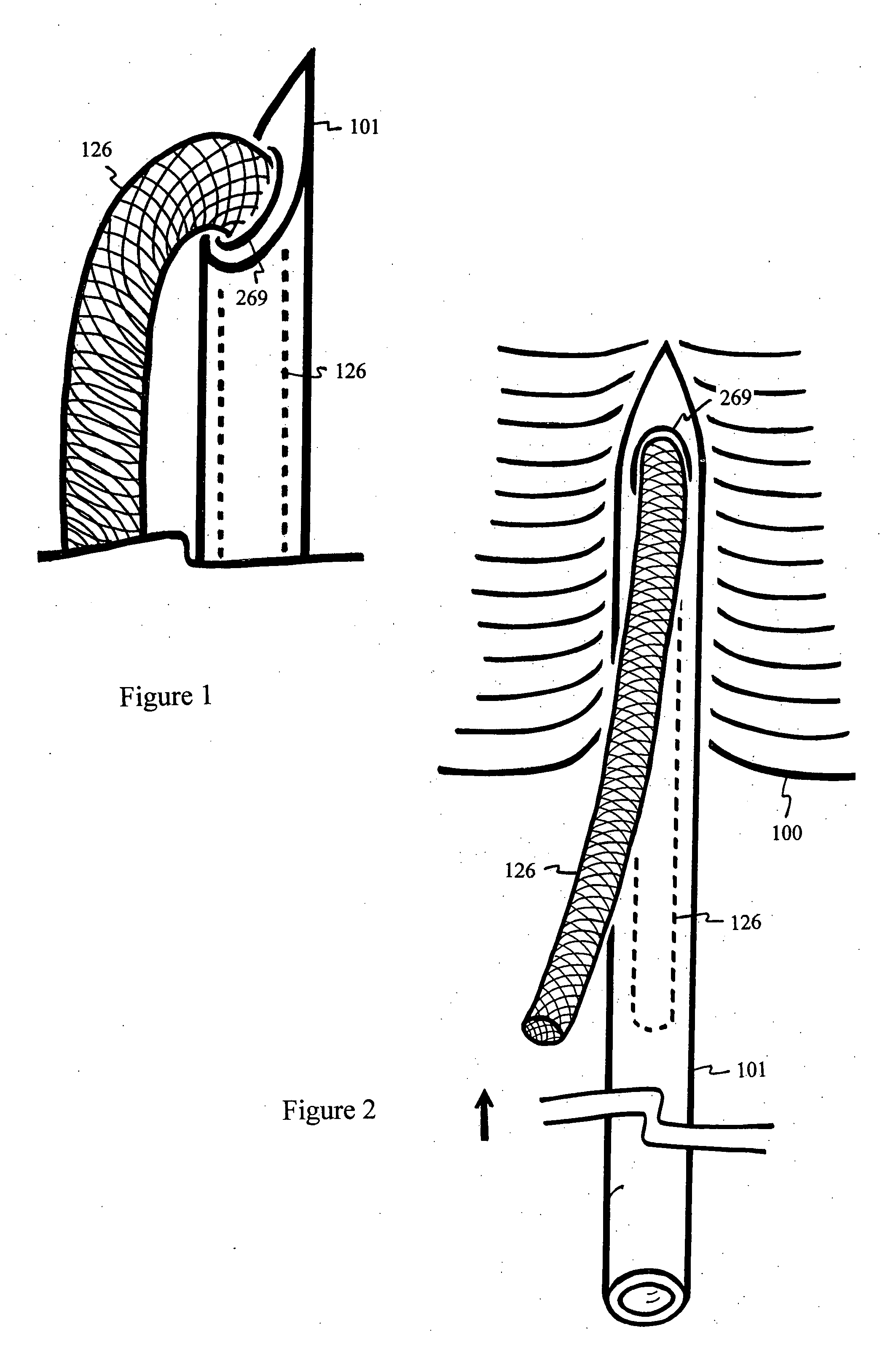 U-shaped disc shunt and delivery device