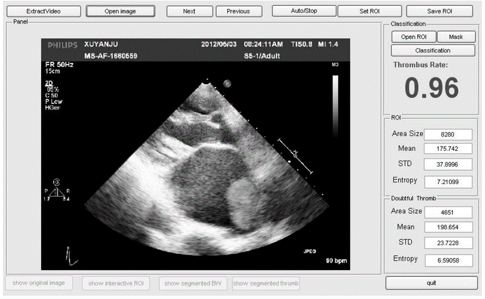Computer-aided ultrasonographic diagnosis of left atrium/left atrial appendage thrombus