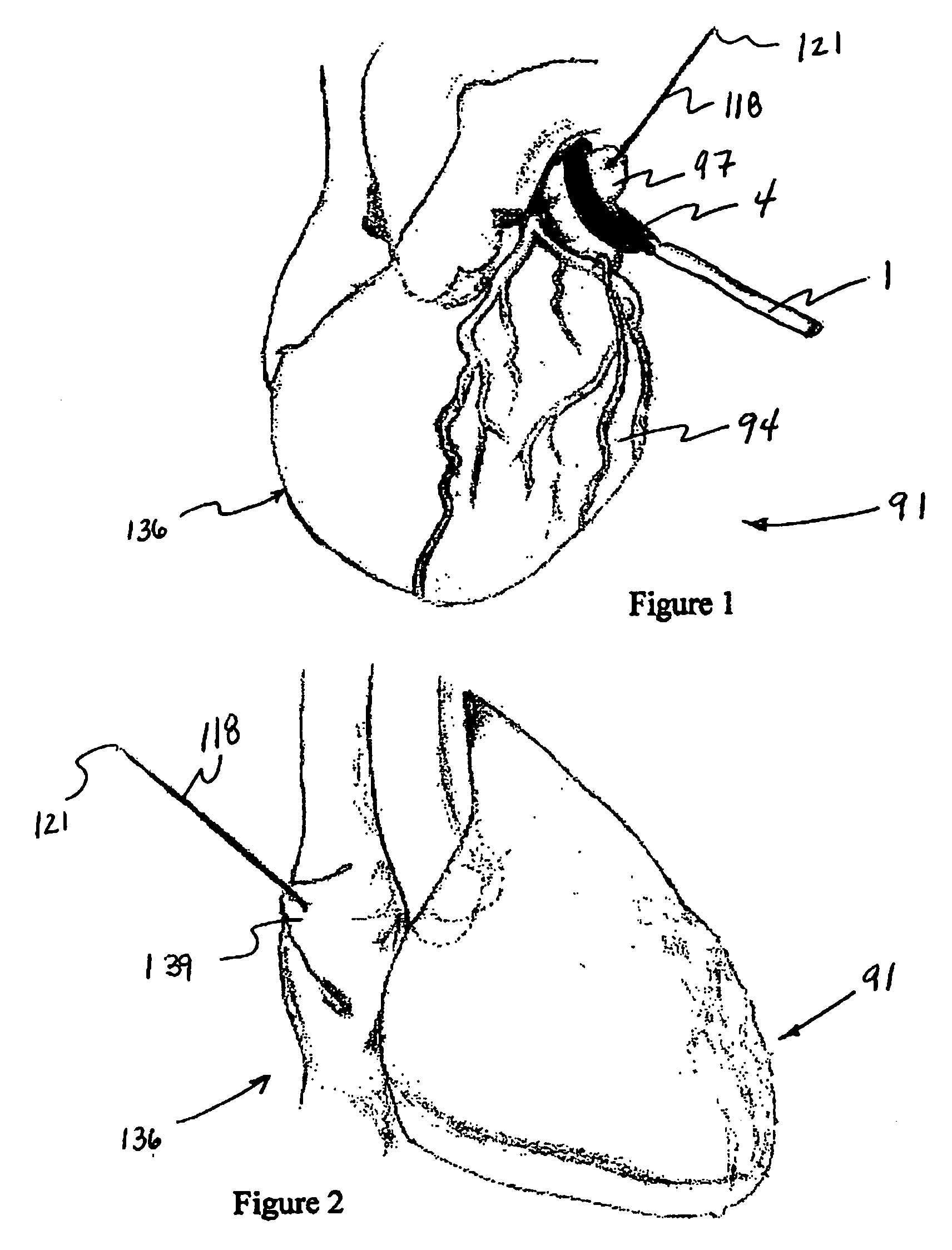 Methods and system for tissue cavity closure