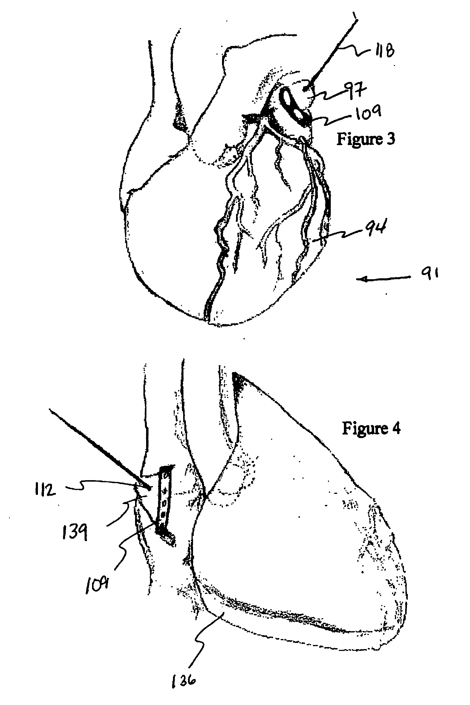 Methods and system for tissue cavity closure