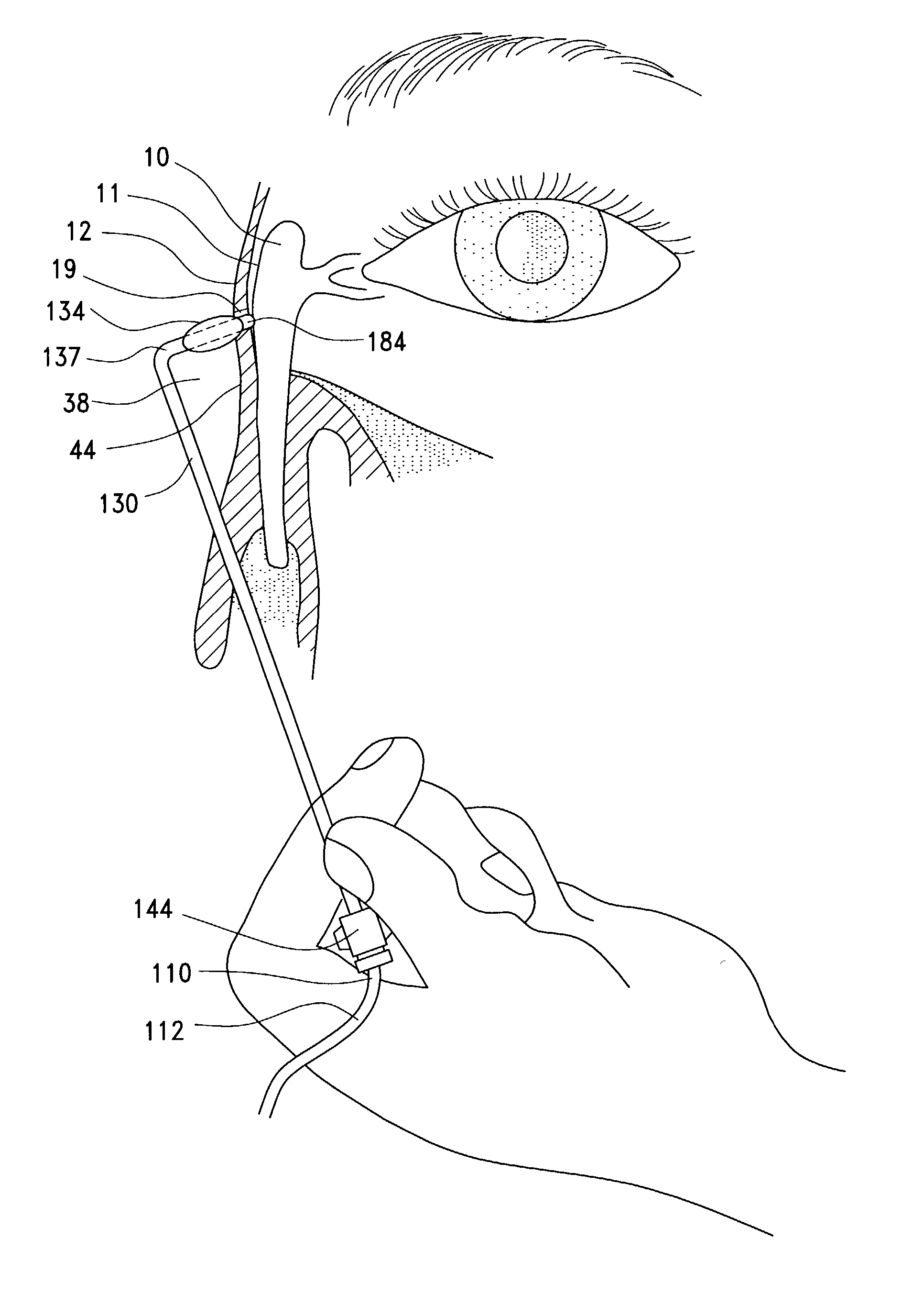 Transnasal method and catheter for lacrimal system