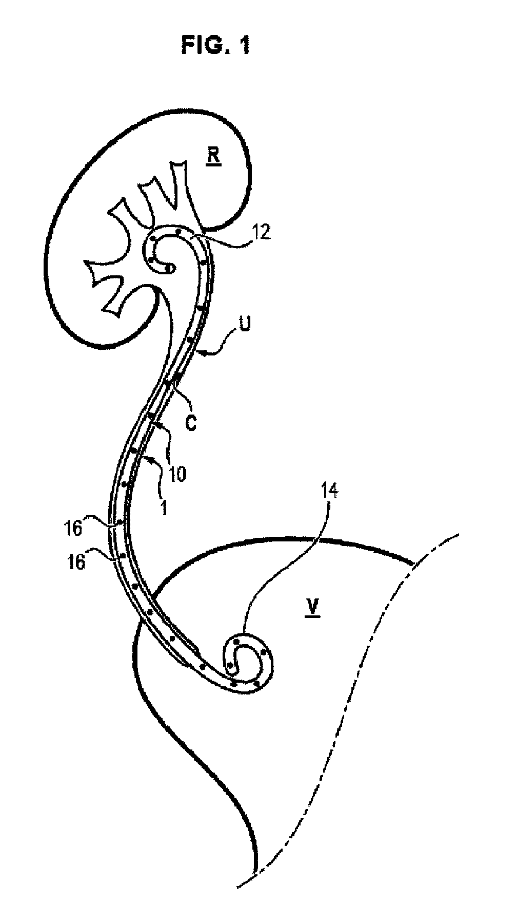 Ureteral stent and method for treating urological problems