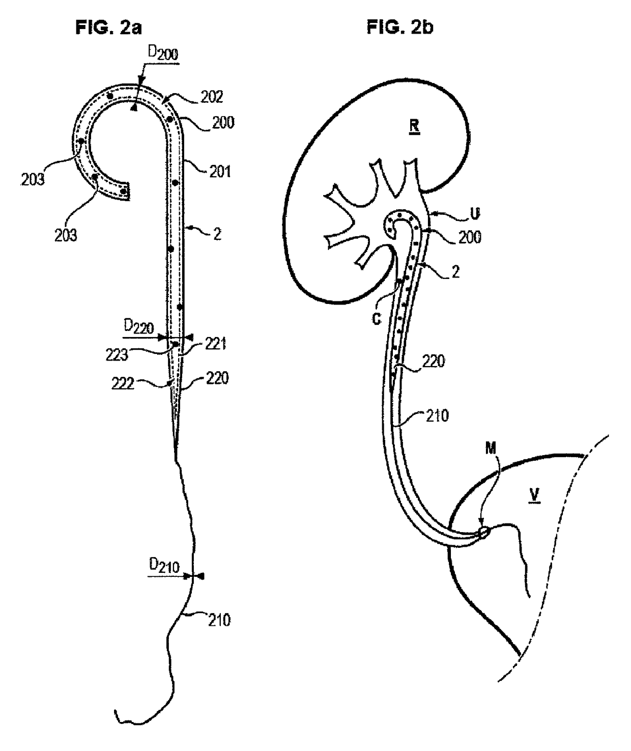 Ureteral stent and method for treating urological problems