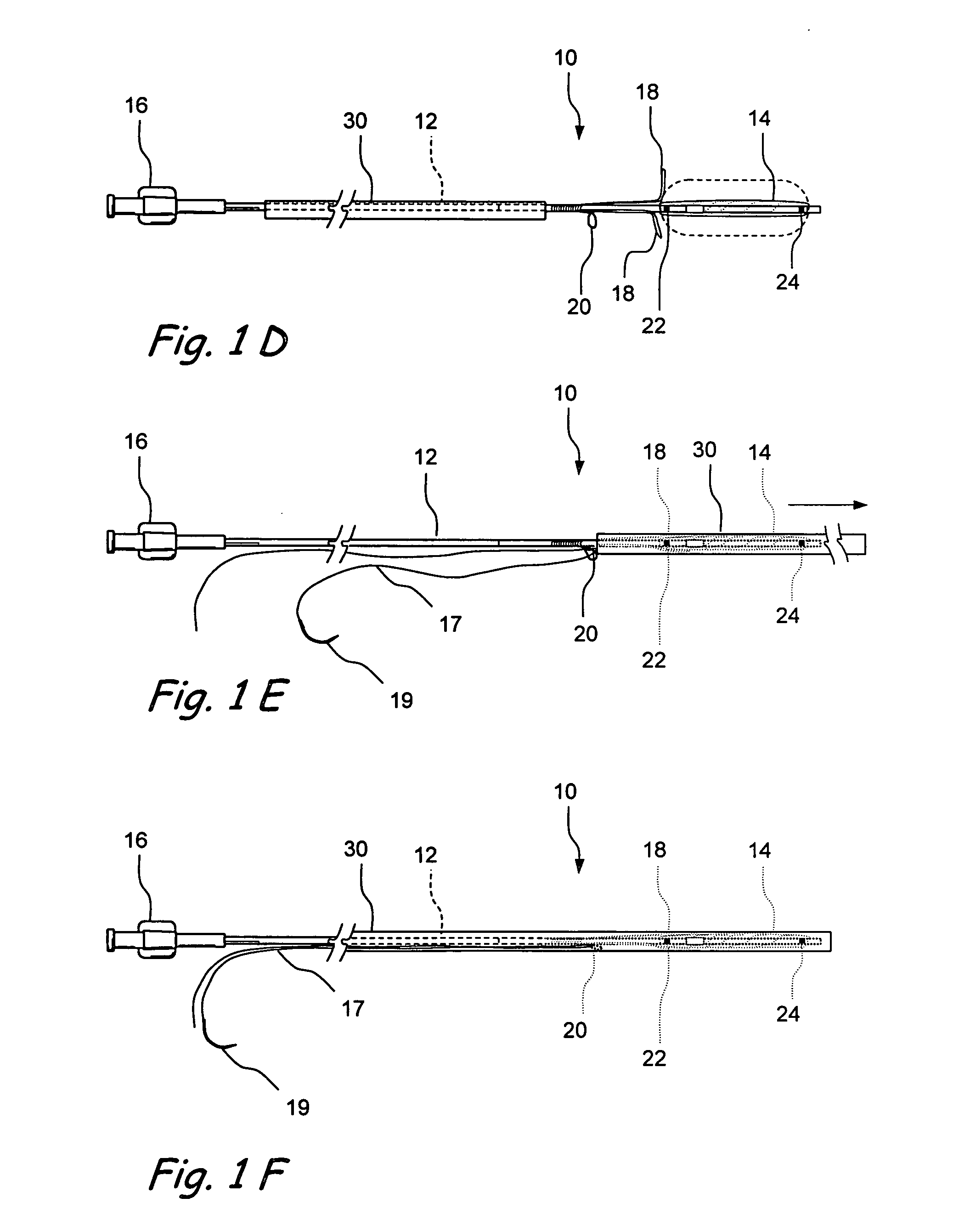 Implantable devices and methods for treating sinusitis and other disorders
