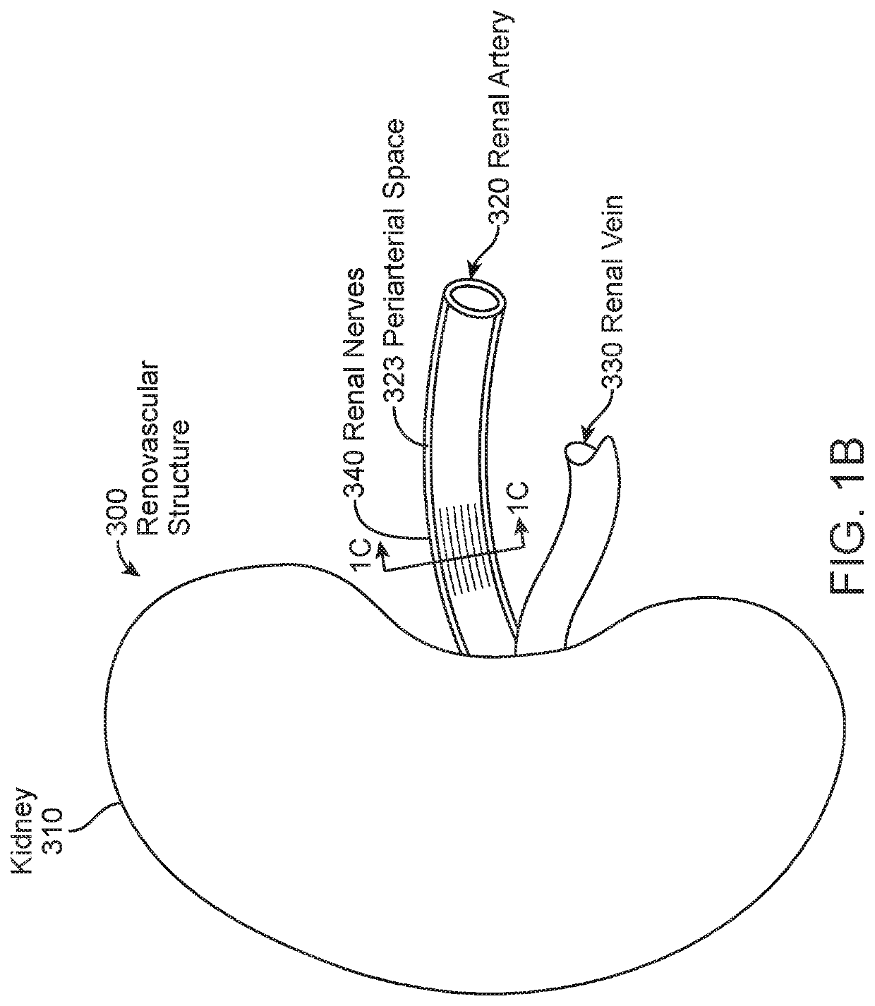 Renovascular treatment device, system, and method for radiosurgically alleviating hypertension