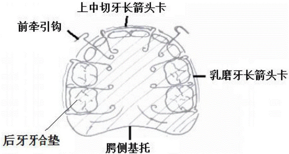 Intraoral maxillary clasp type occlusal pad reverse headgear appliance for orthodontics of skeletal crossbite