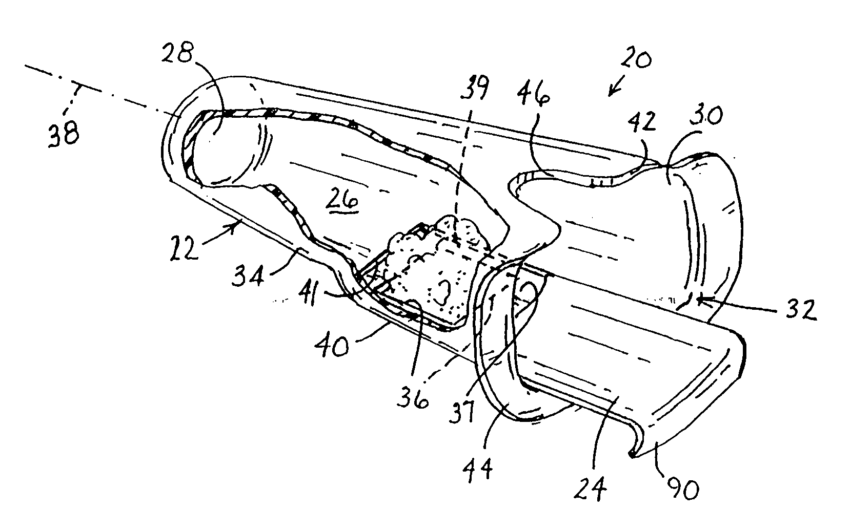 Endoluminal treatment method and associated surgical assembly including tissue occlusion device