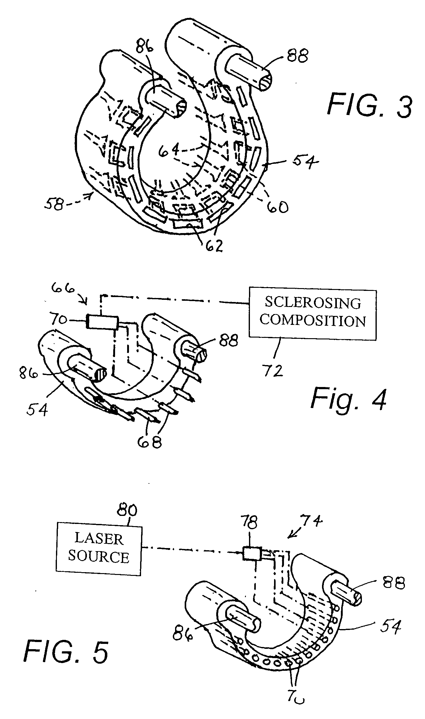 Endoluminal treatment method and associated surgical assembly including tissue occlusion device