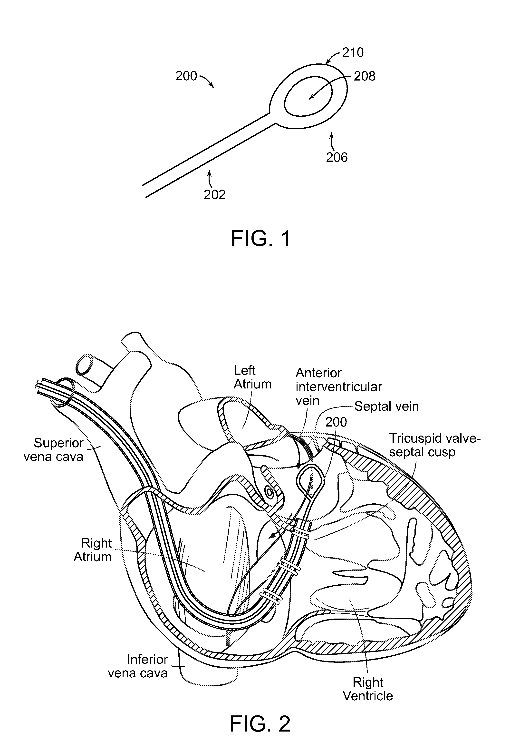 Methods and devices for transcatheter cerclage annuloplasty